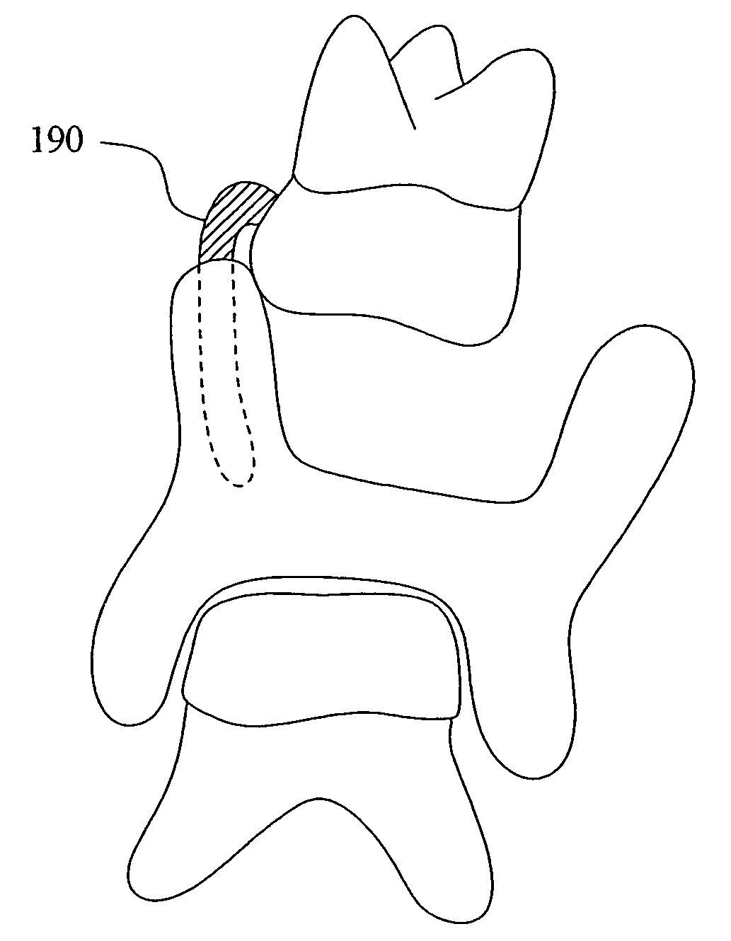 System of dental appliances having various sizes and types and a method for treating malocclusions of patients of various ages without adjustments or appointments