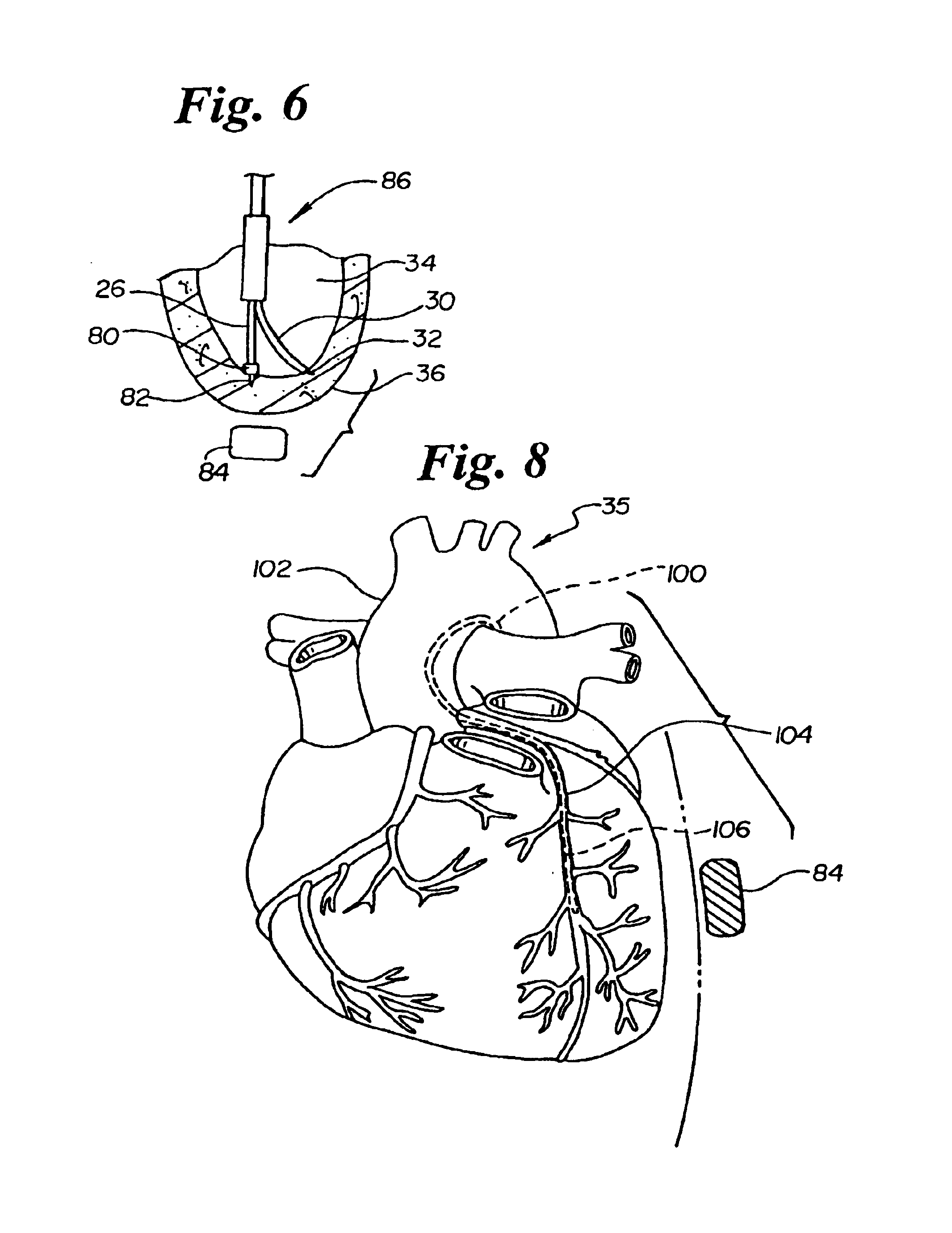 Percutaneous myocardial revascularization device and method