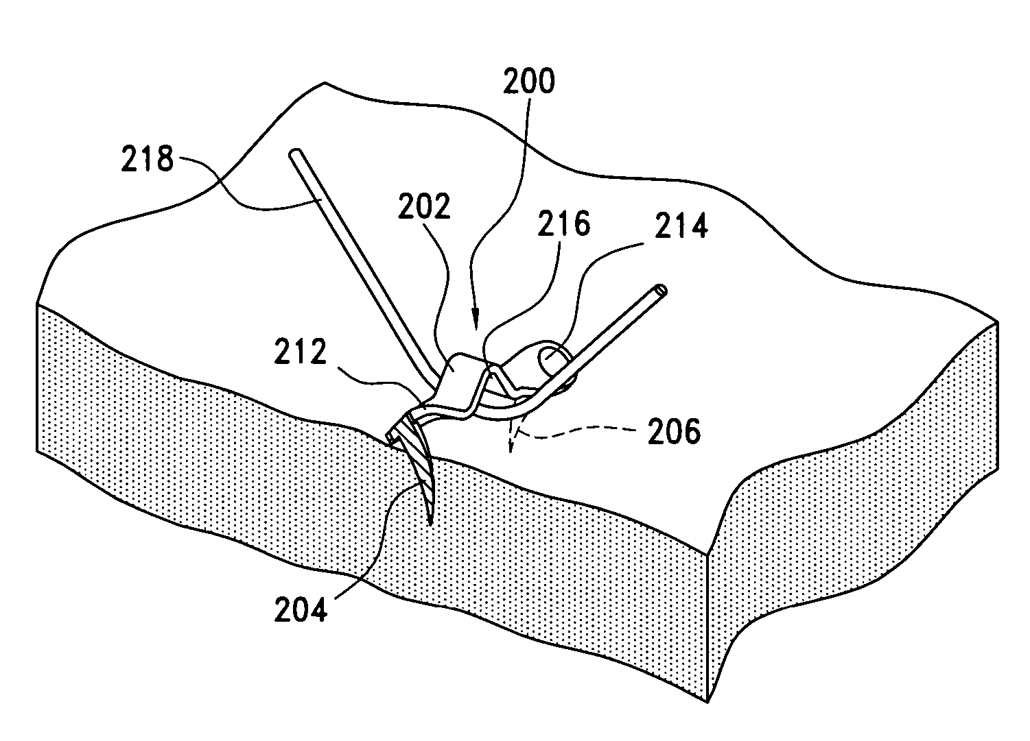 Fasteners for use with gastric restriction