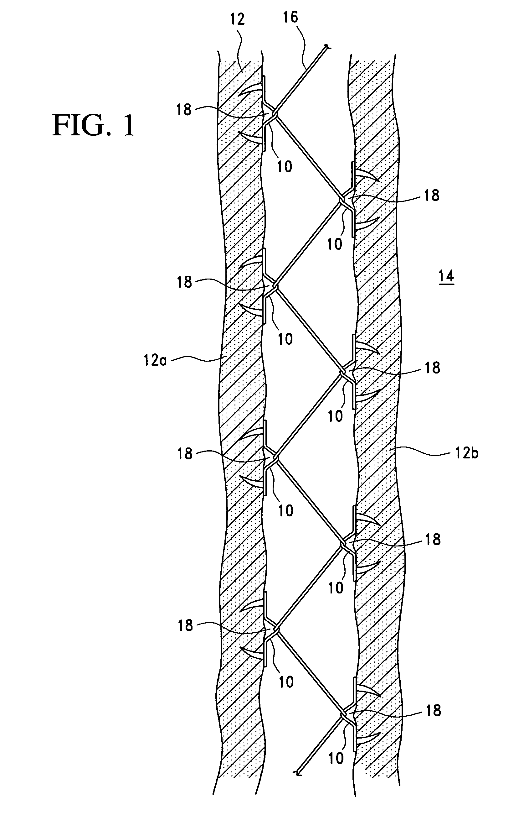 Fasteners for use with gastric restriction