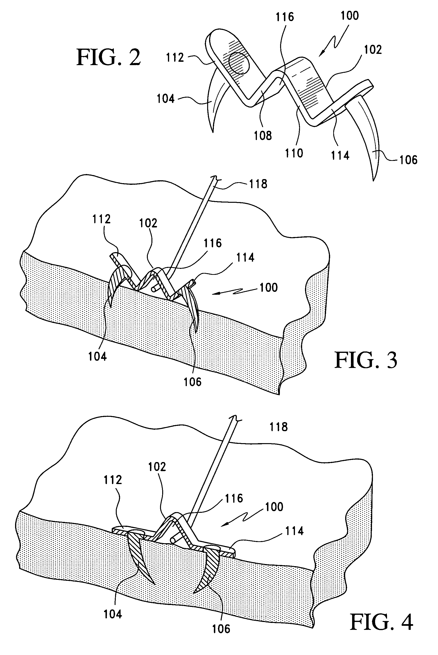 Fasteners for use with gastric restriction