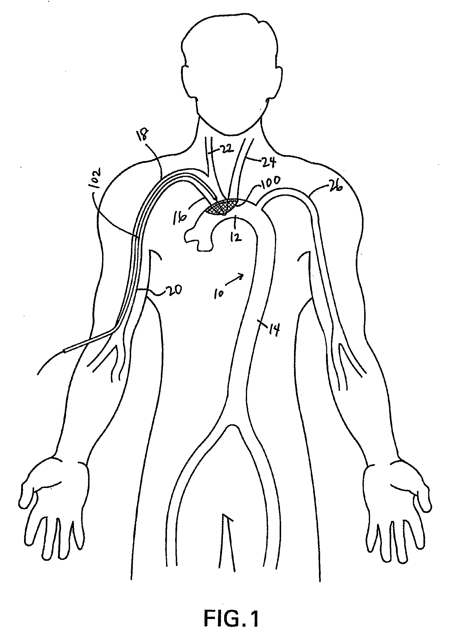 Embolic deflection device