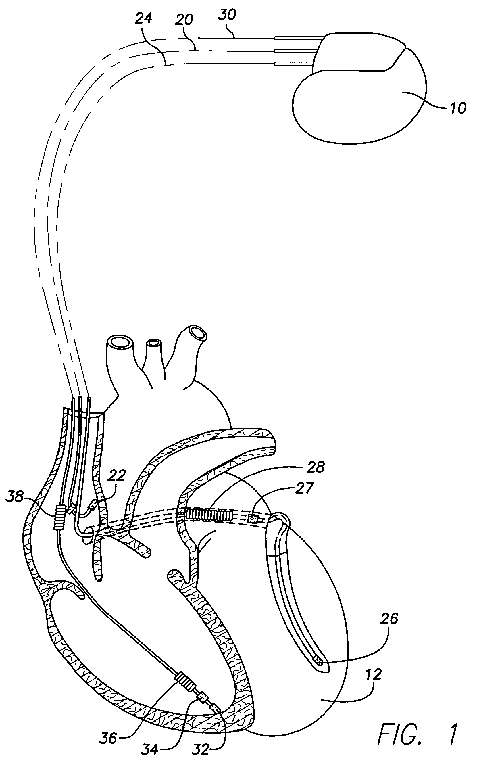 Method and system to graphically display programming parameters for multi-chamber devices