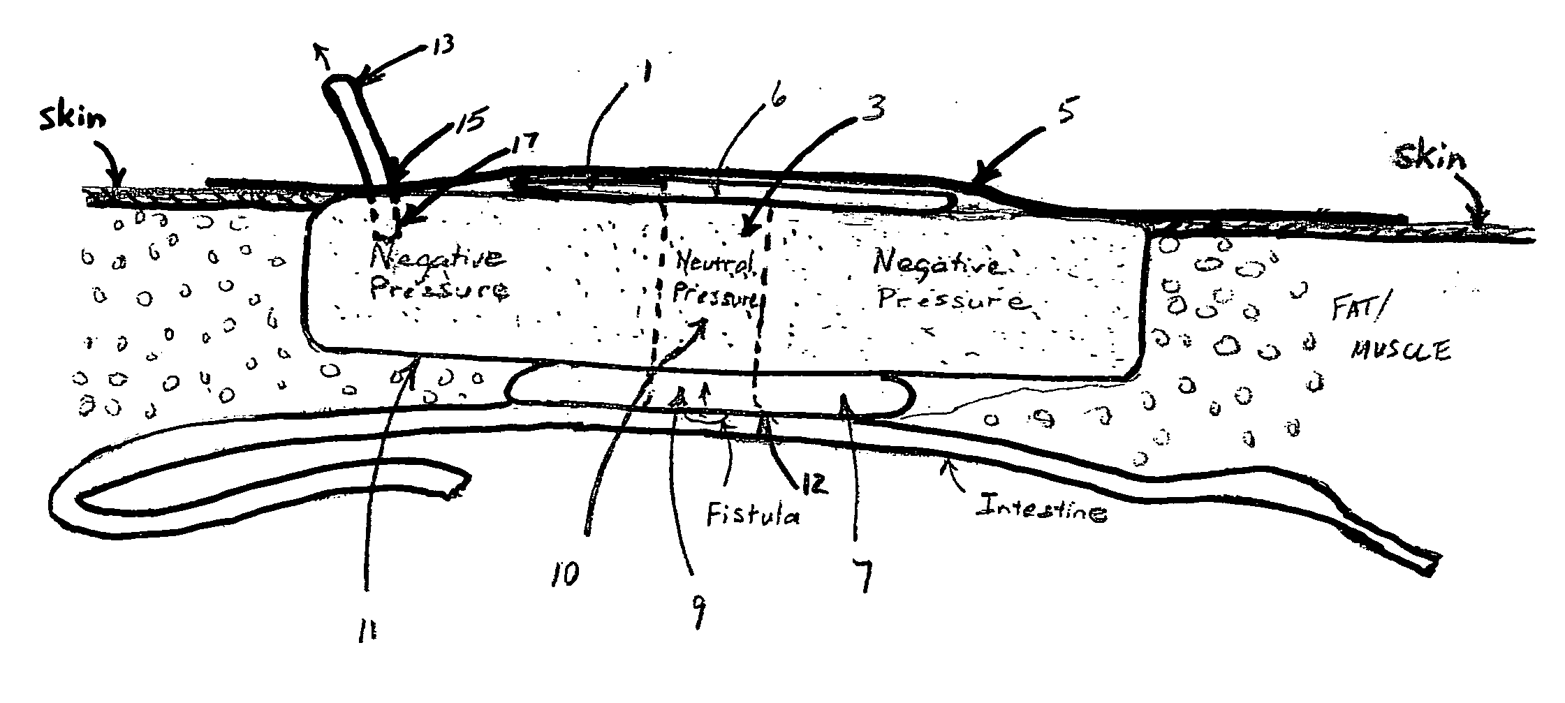 Fluid isolation device and method for treatment of fistulas