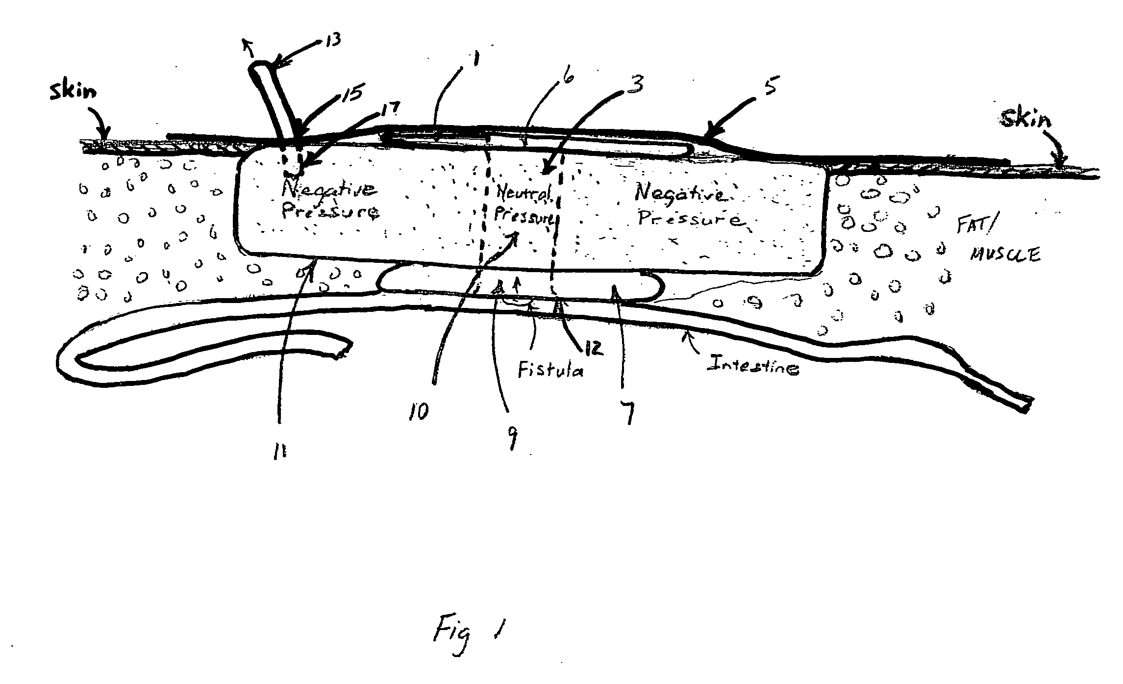 Fluid isolation device and method for treatment of fistulas