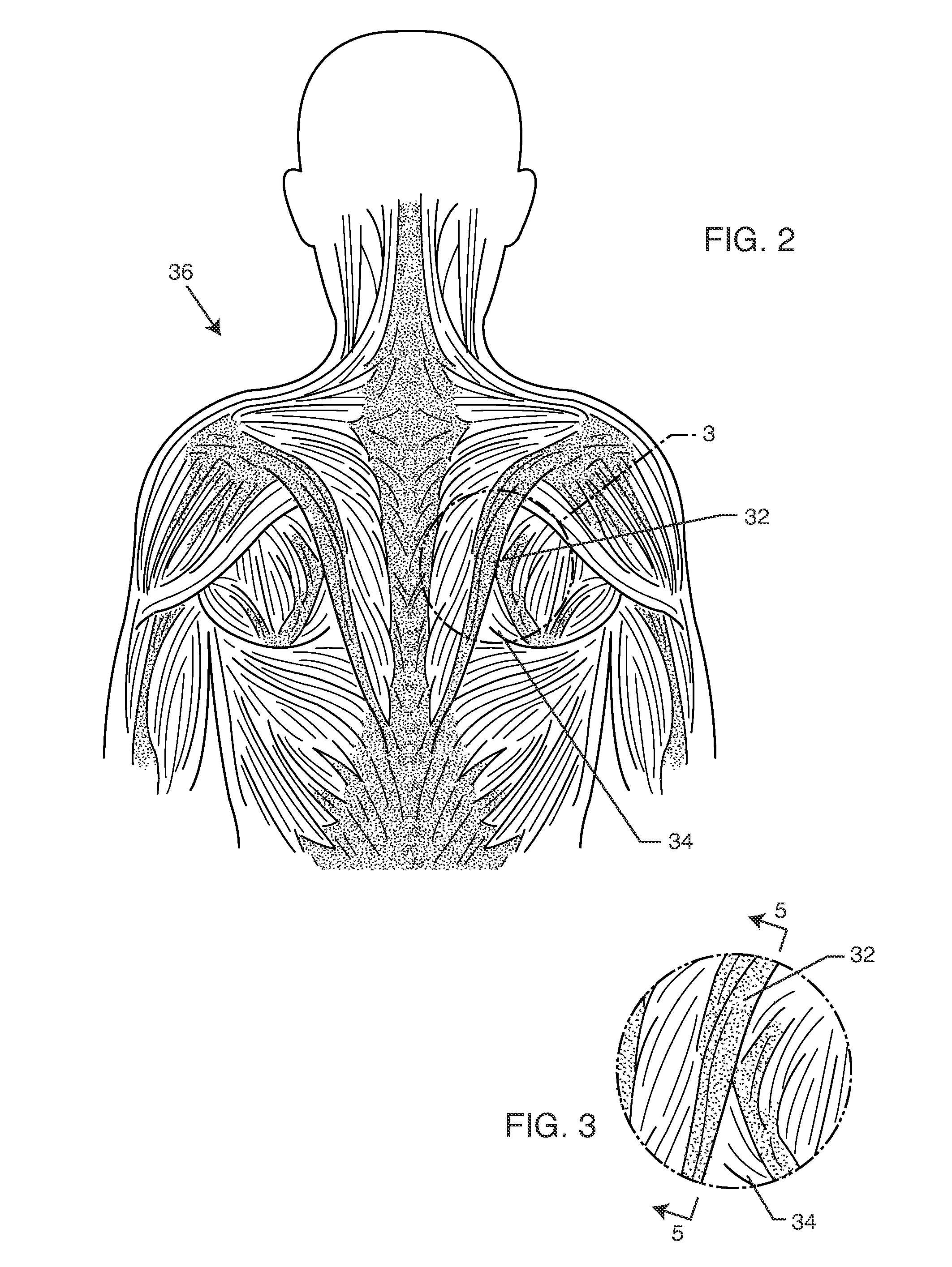 Process and apparatus for soft tissue manipulation