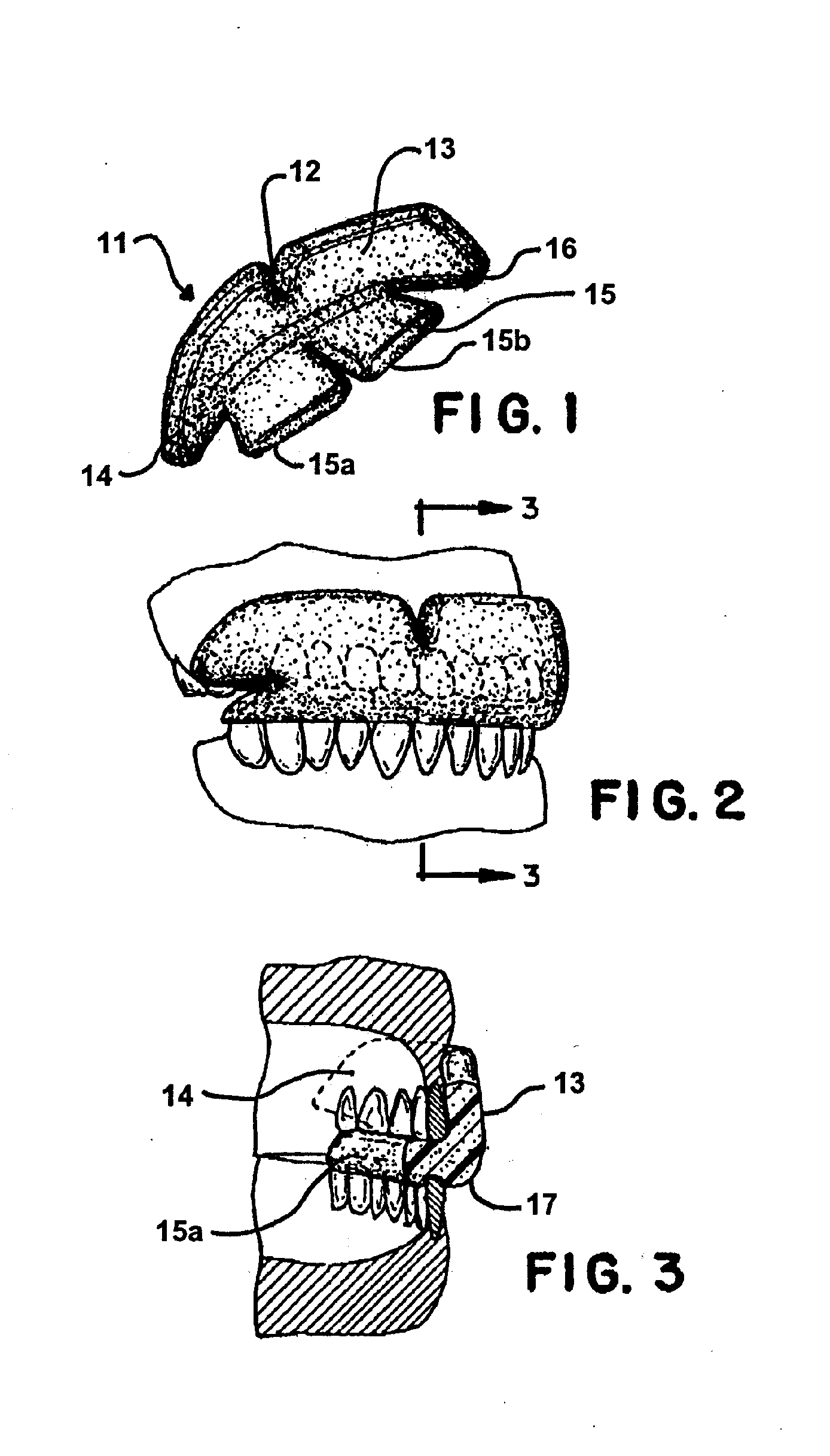 Molded foam mouthguard