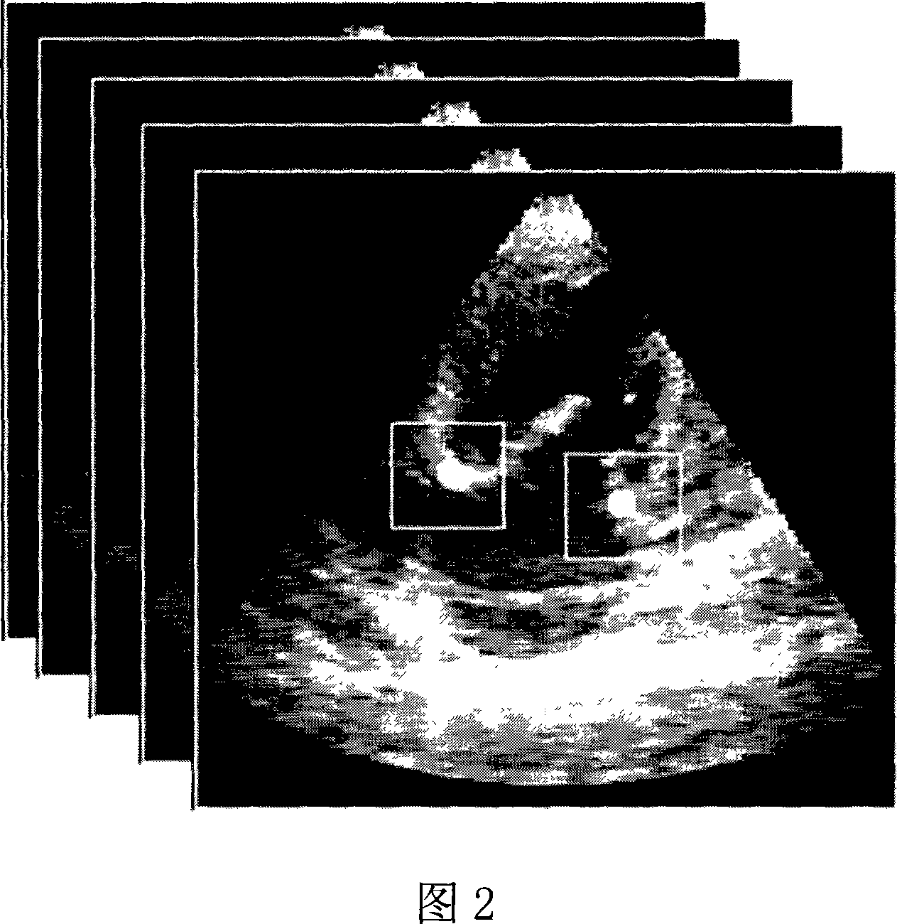 Method for computer-assisted rebuilding heart mitral annulus