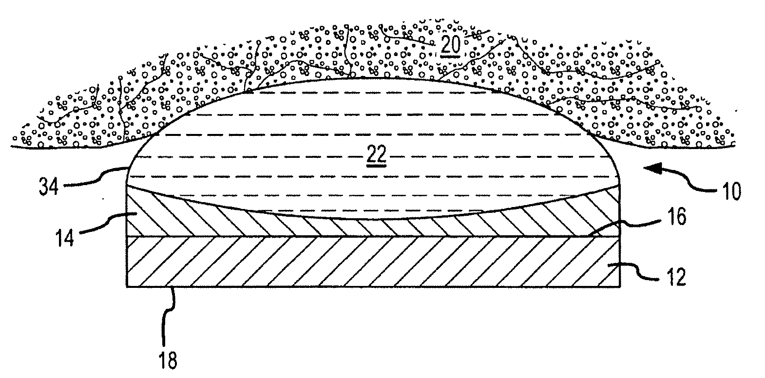 High intensity focused ultrasound transducer with accoustic lens