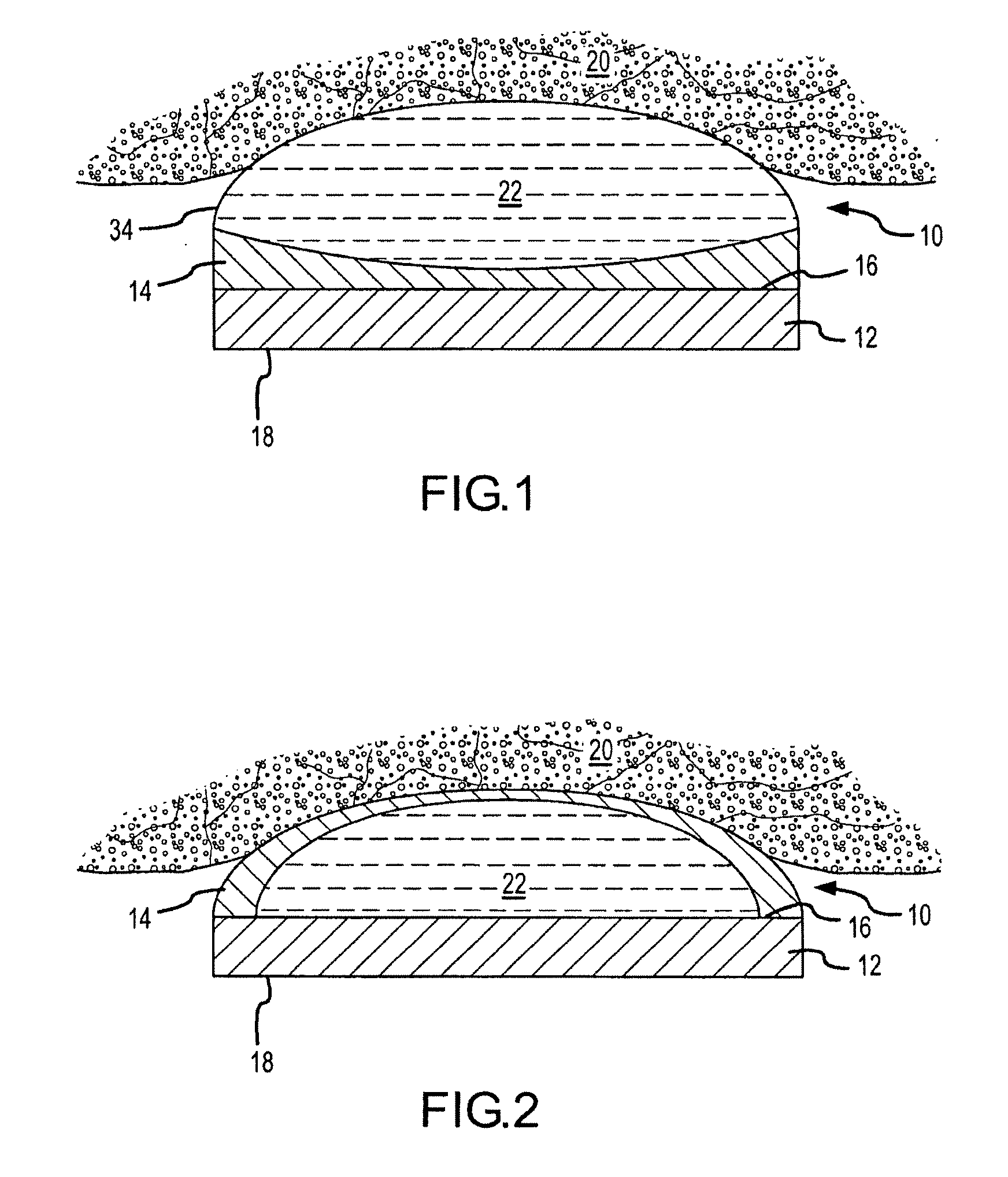 High intensity focused ultrasound transducer with accoustic lens