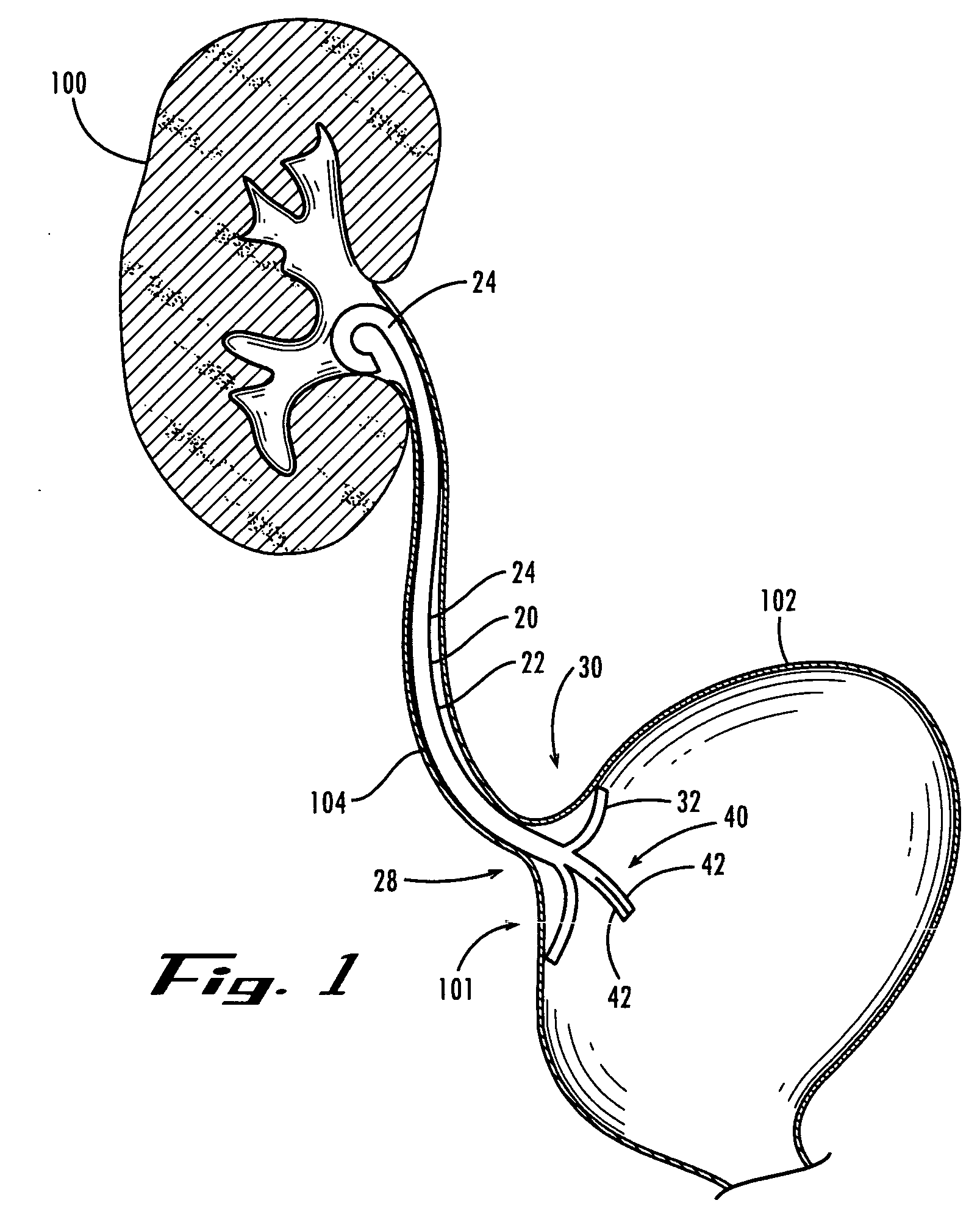 Ureteral stent