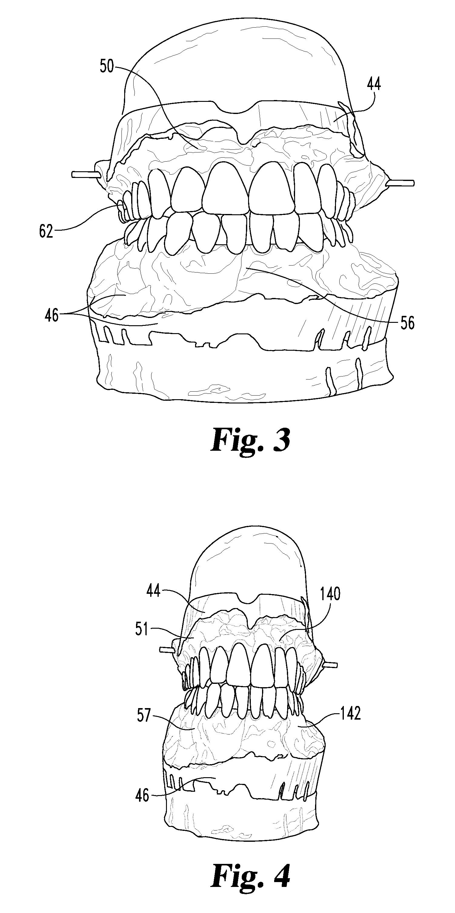 Dental prosthetic