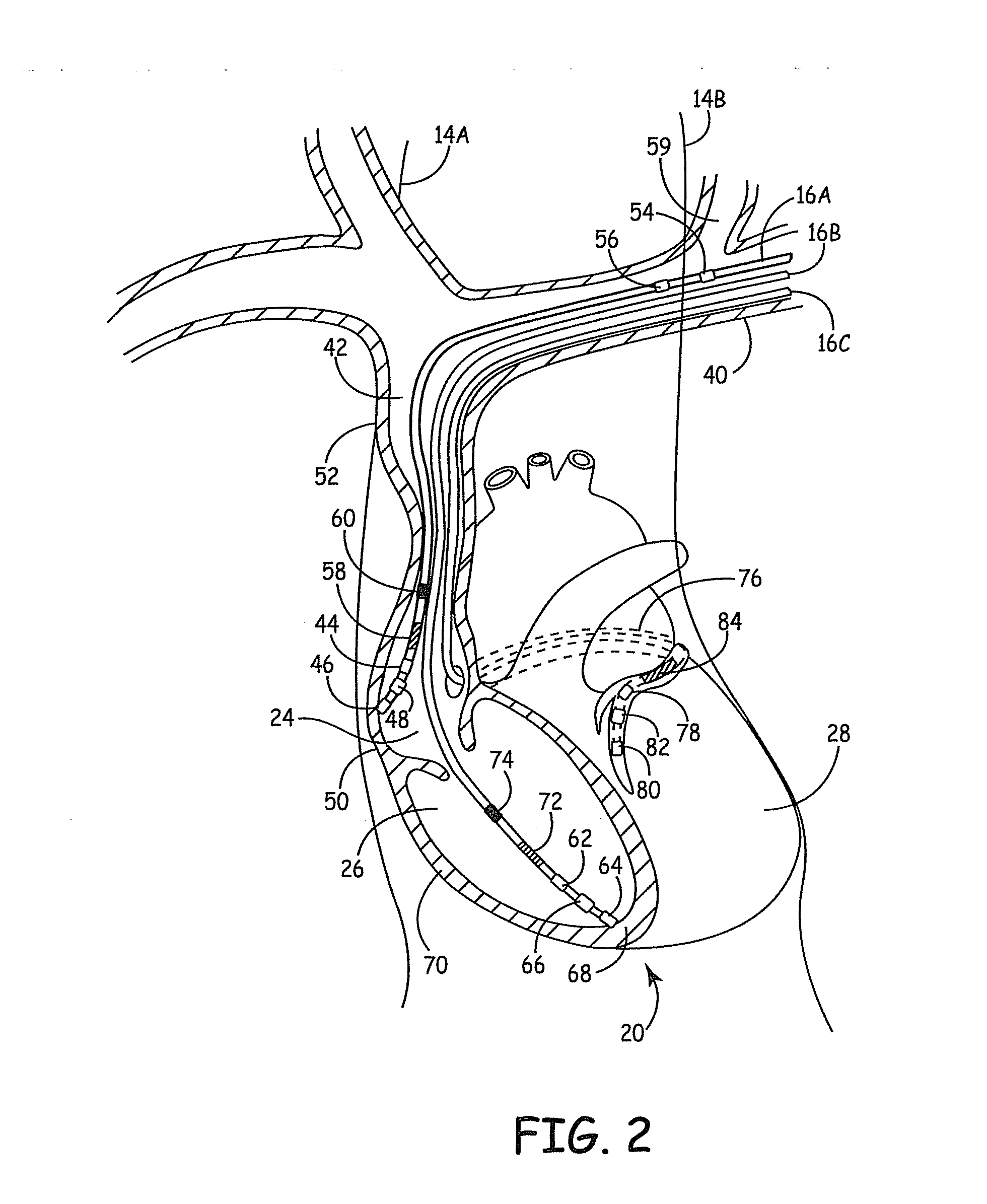 Medical device to provide breathing therapy