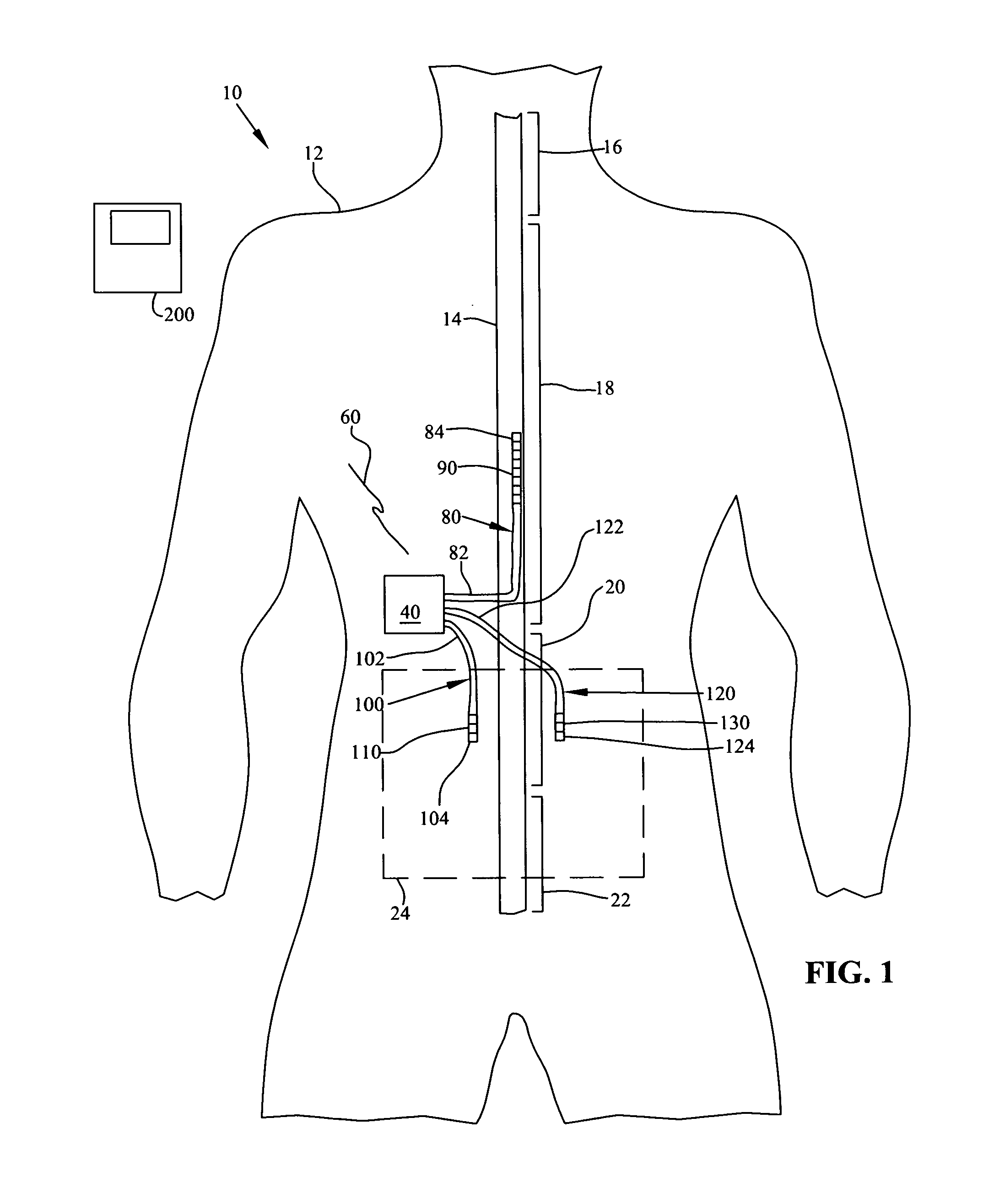 System and method for treating pain with peripheral and spinal neuromodulation