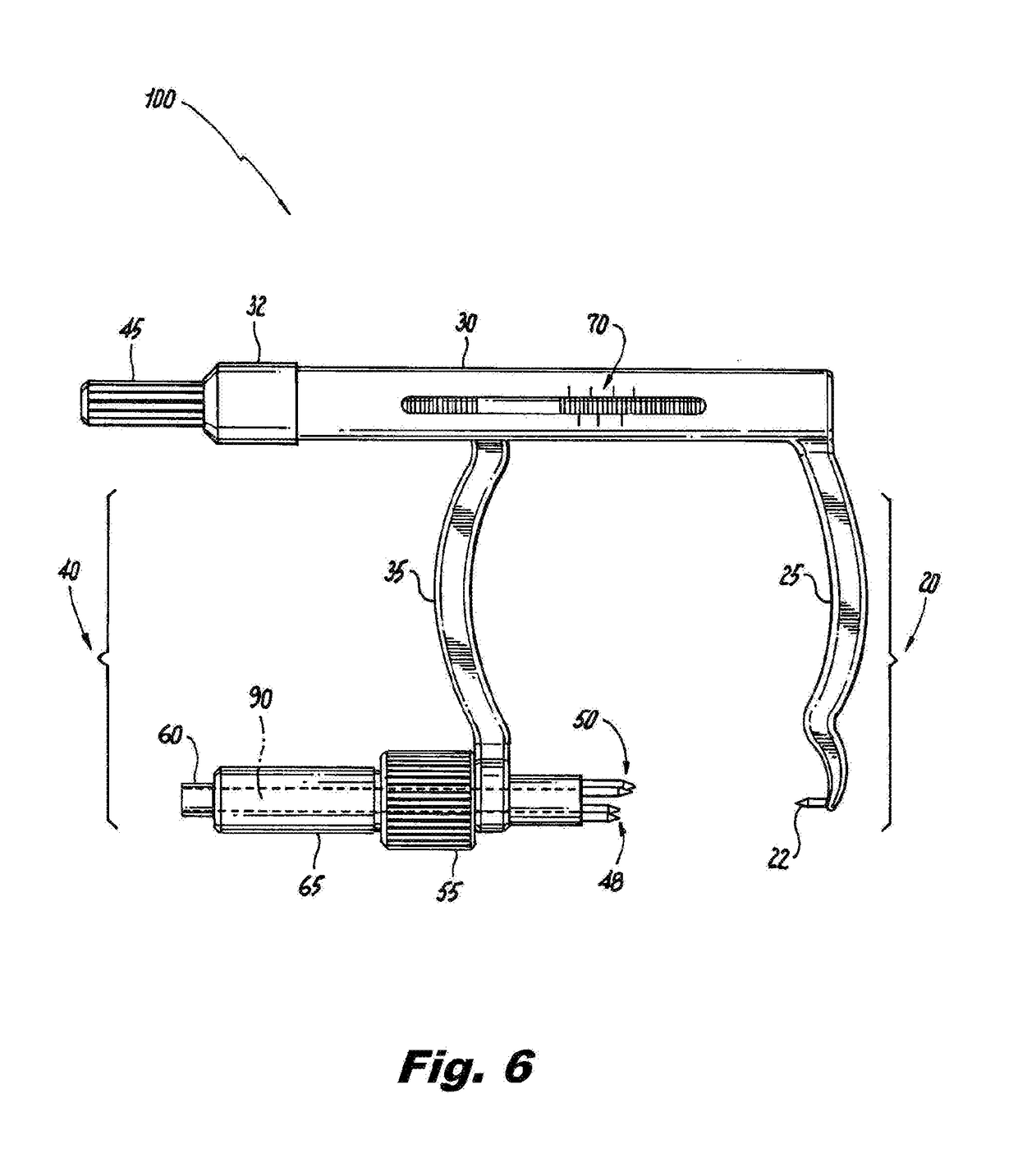 Methods, instruments and implants for scapho-lunate reconstruction