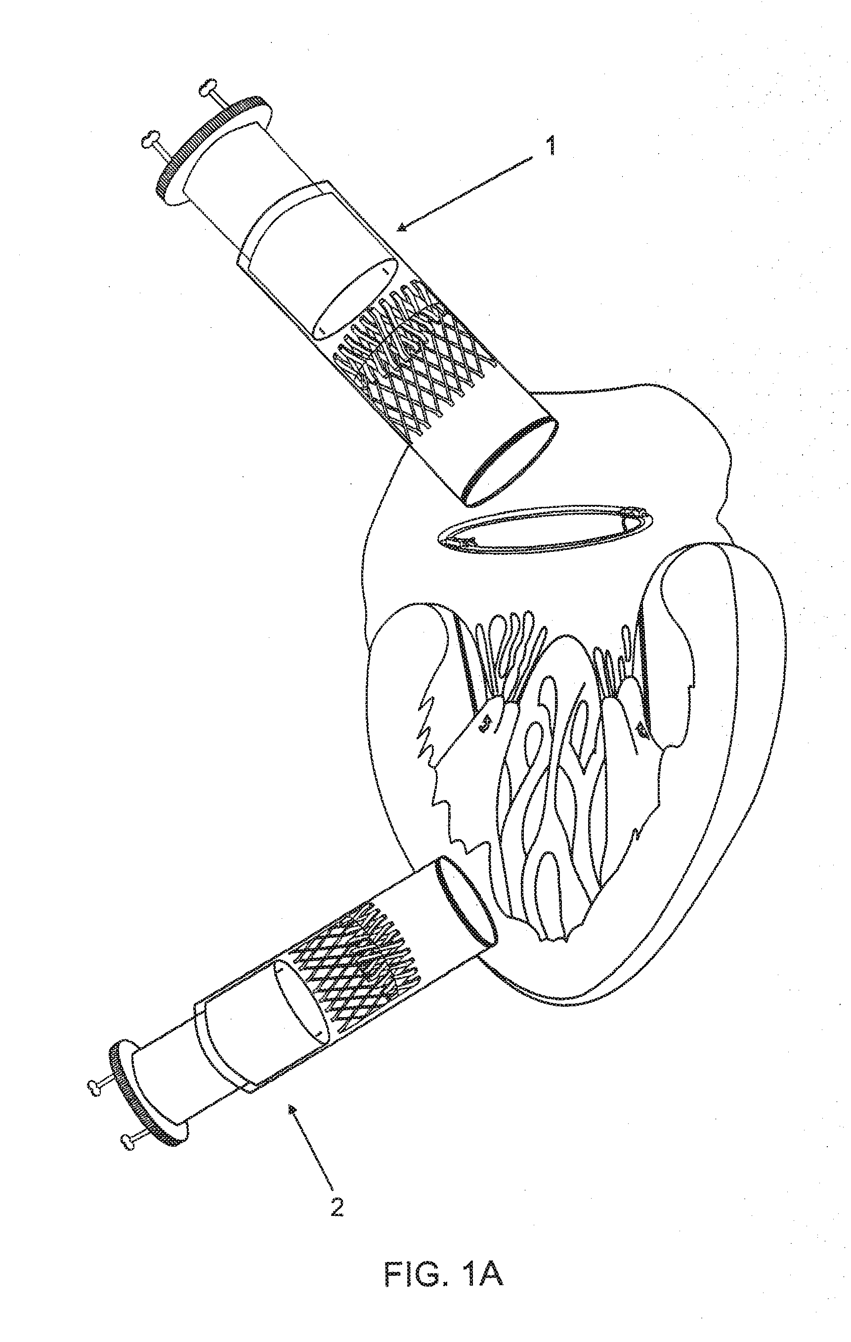 Stent With Mechanical Or Biological Heart Valve For Minimally Invasive Valve Replacement Procedure And Stent Application Device