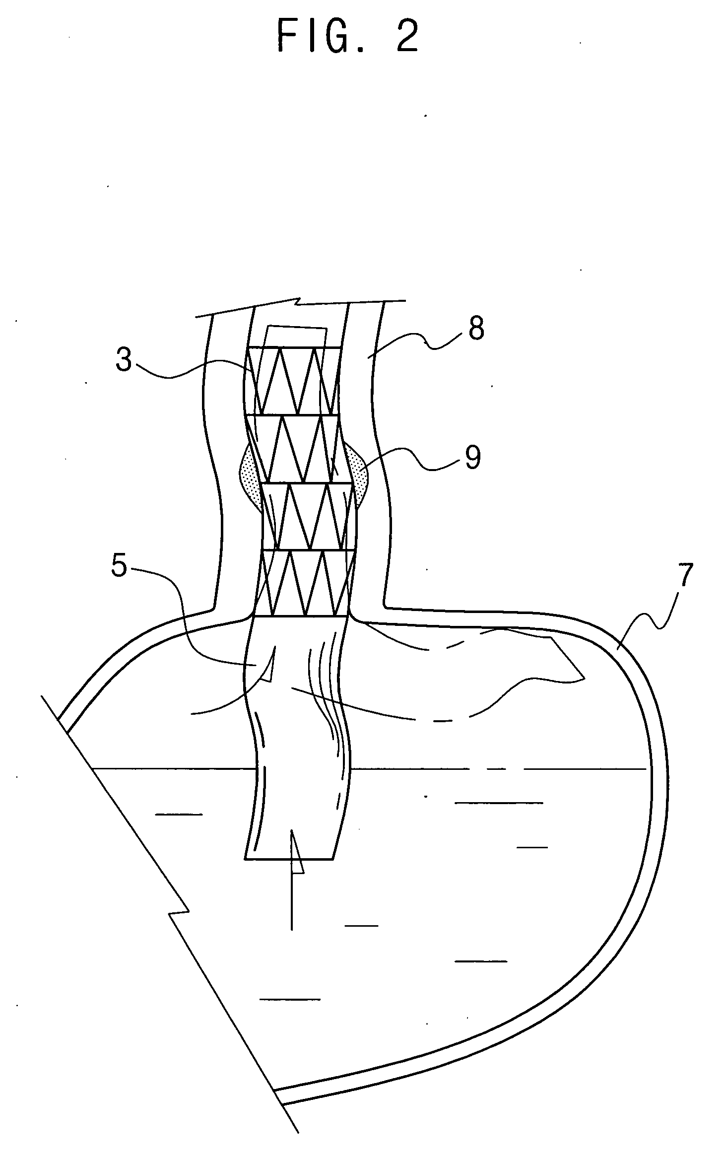 Esophageal stent