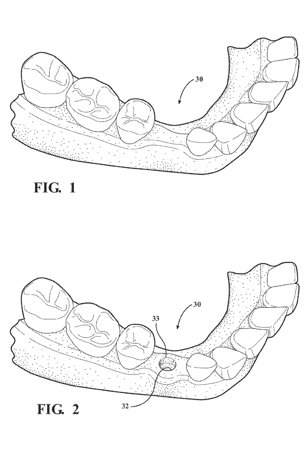 Autografting tool with enhanced flute profile and methods of use