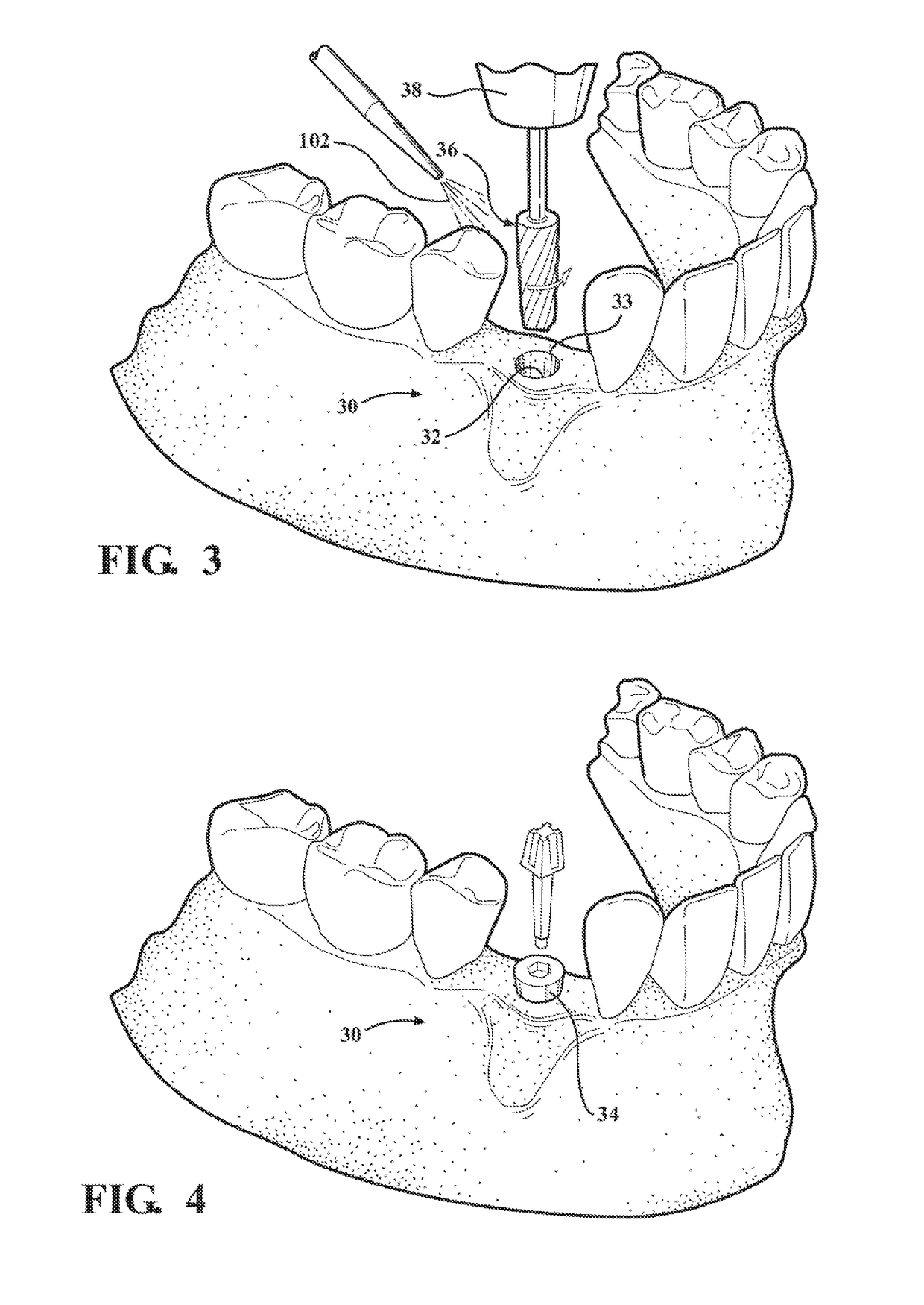 Autografting tool with enhanced flute profile and methods of use