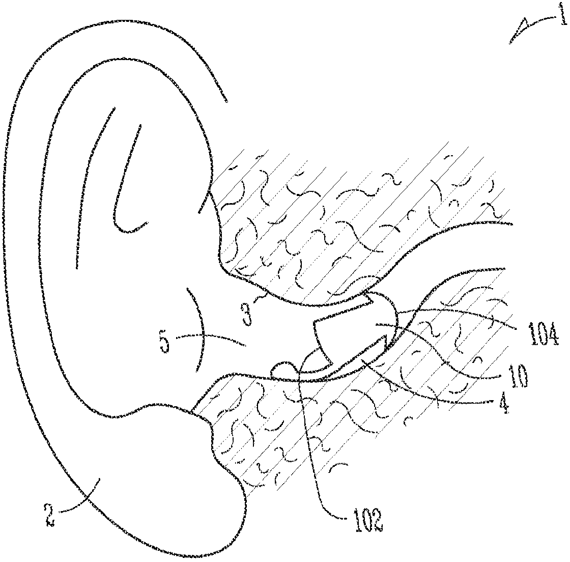 Extended wear hearing assistance device