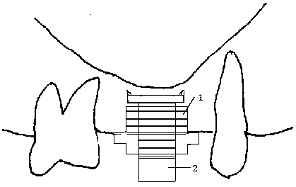 Maxillary sinus floor lifting device and method