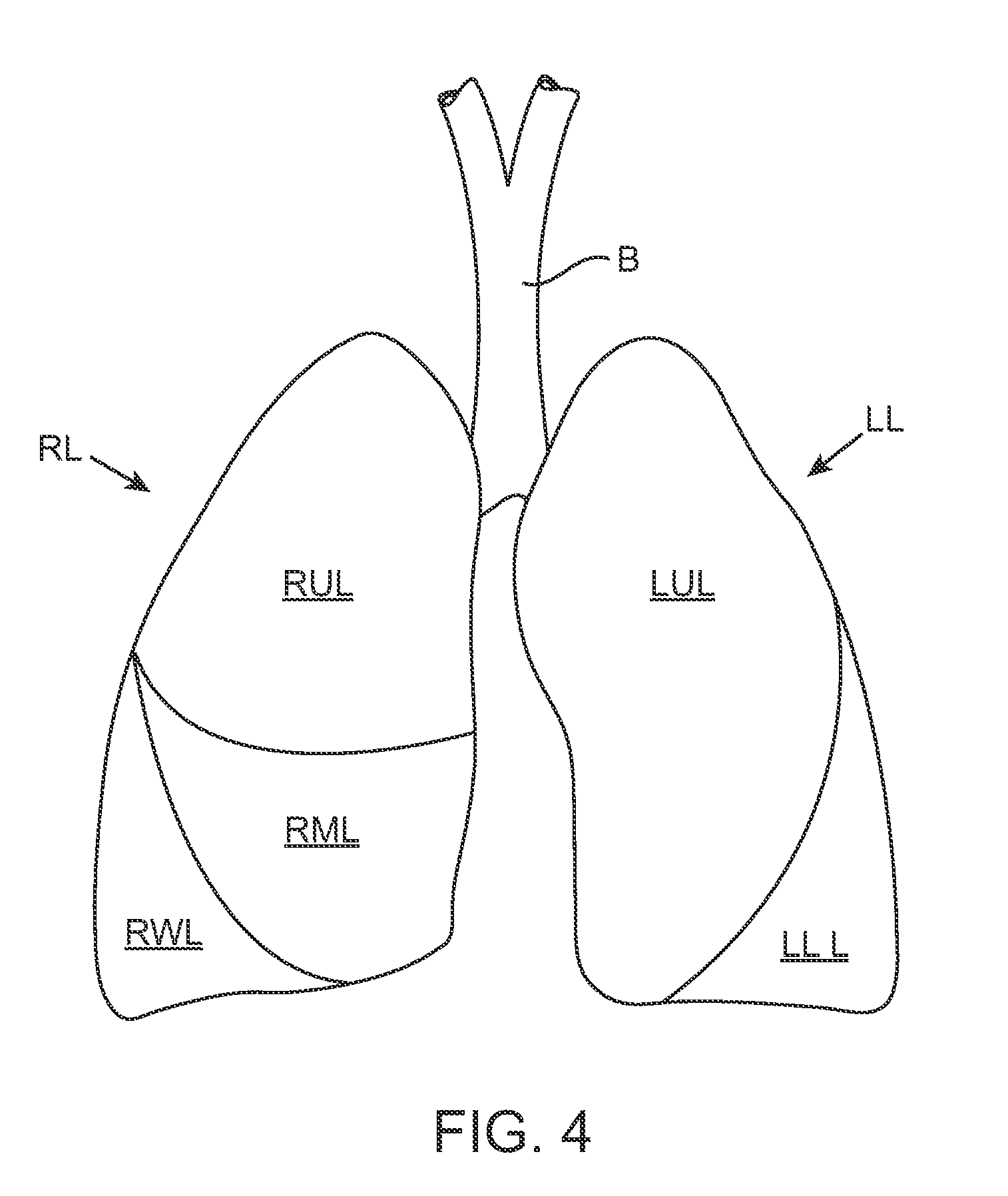 Methods and systems for occluding collateral flow channels in the lung