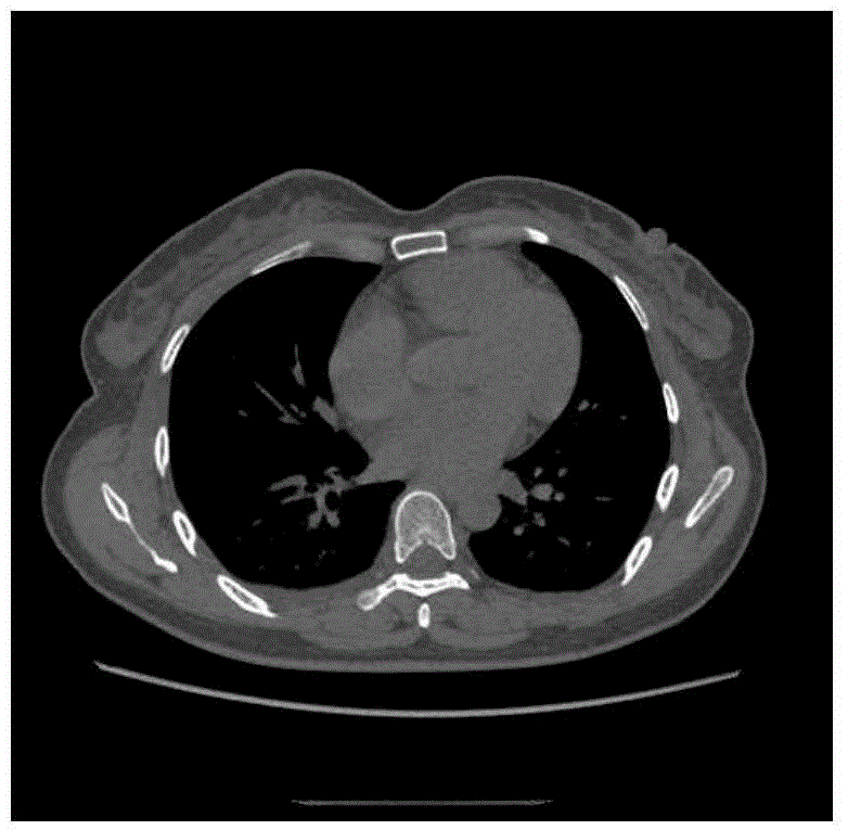 Image Restoration Method of CT Sequence Based on Low Rank Decomposition