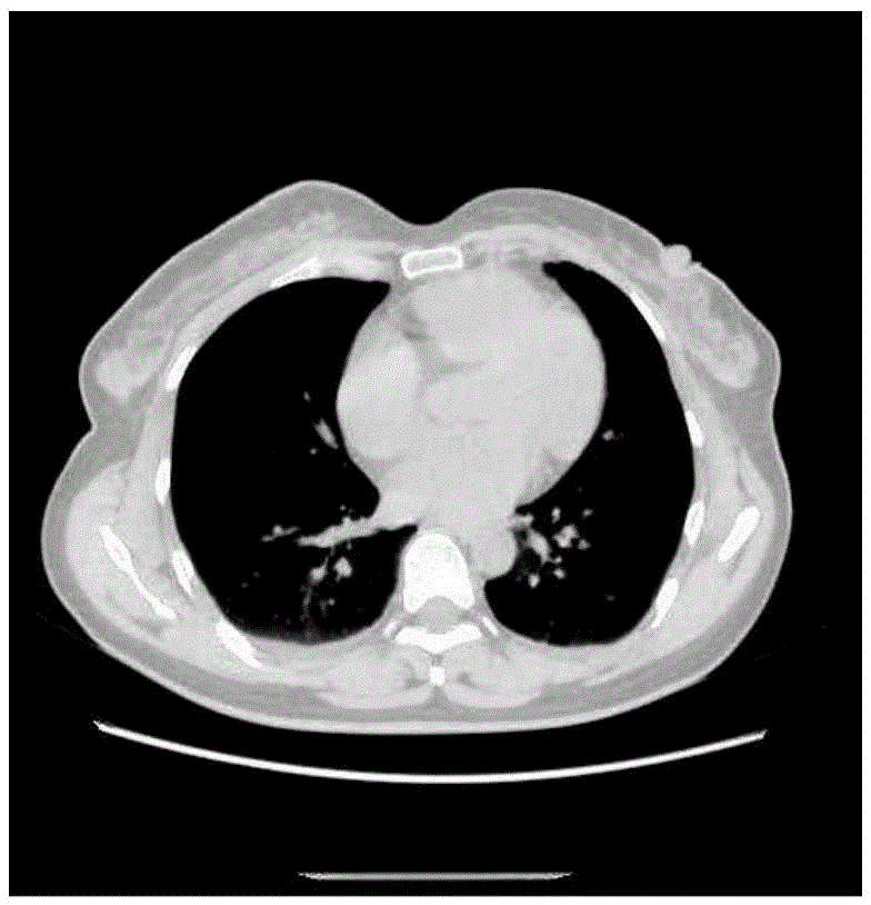 Image Restoration Method of CT Sequence Based on Low Rank Decomposition