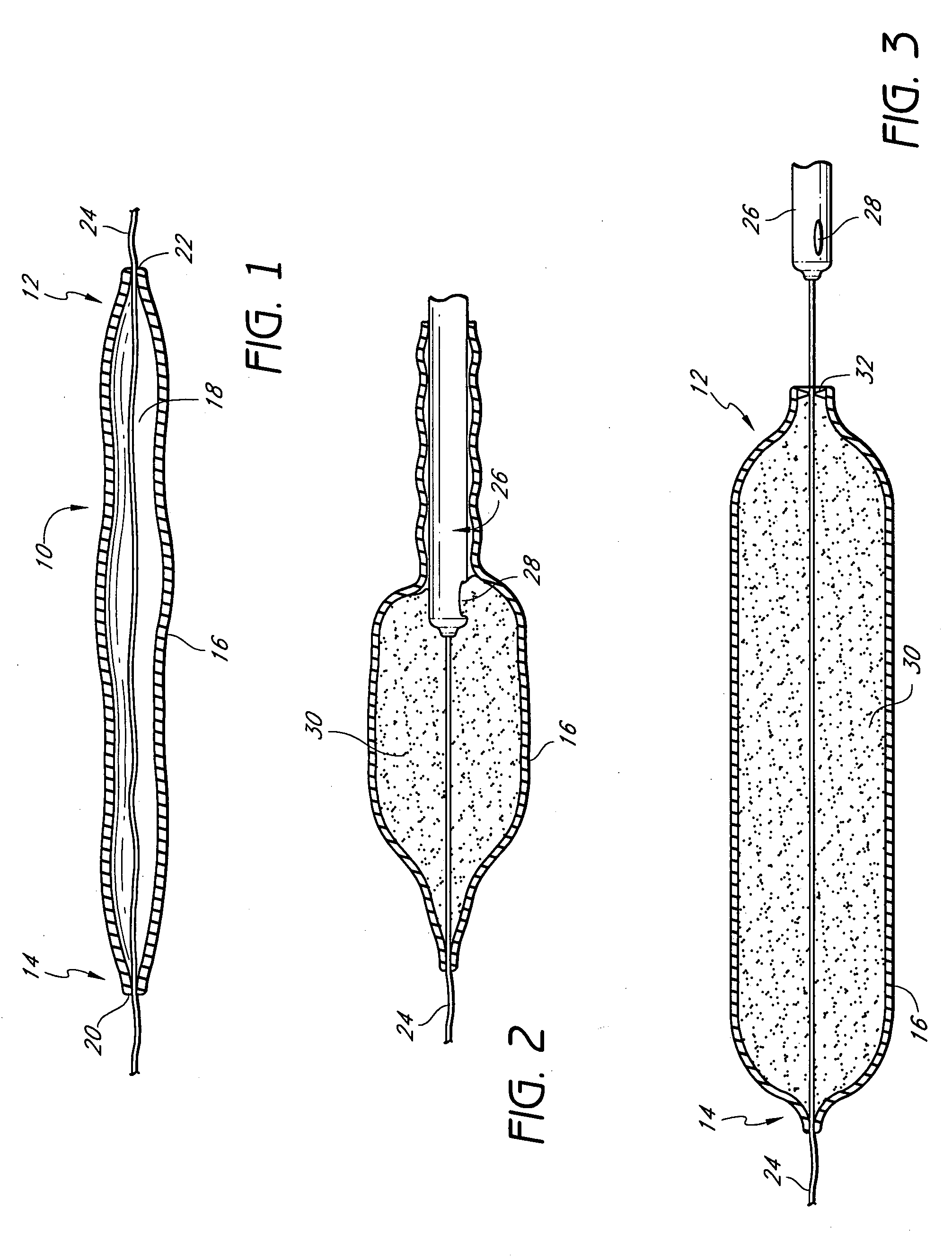 Valved tissue augmentation implant