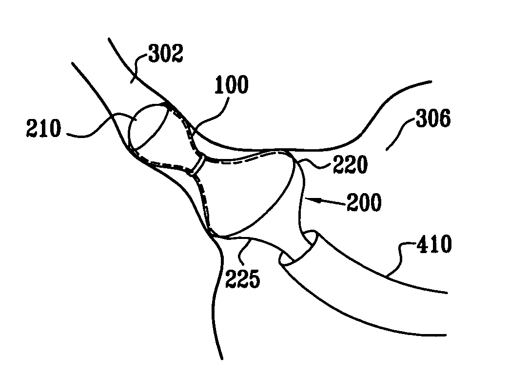 Varying-diameter vascular implant and balloon