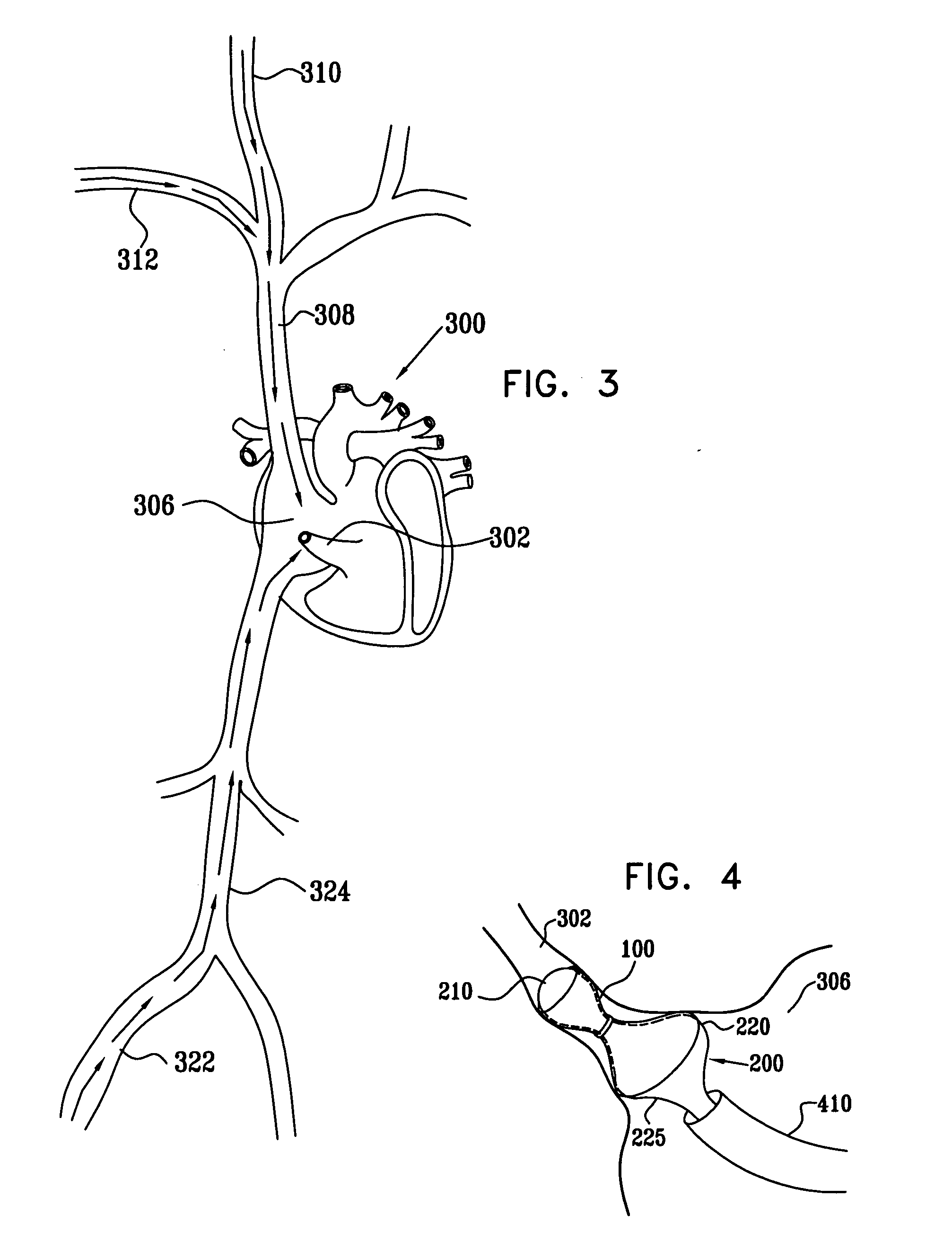 Varying-diameter vascular implant and balloon