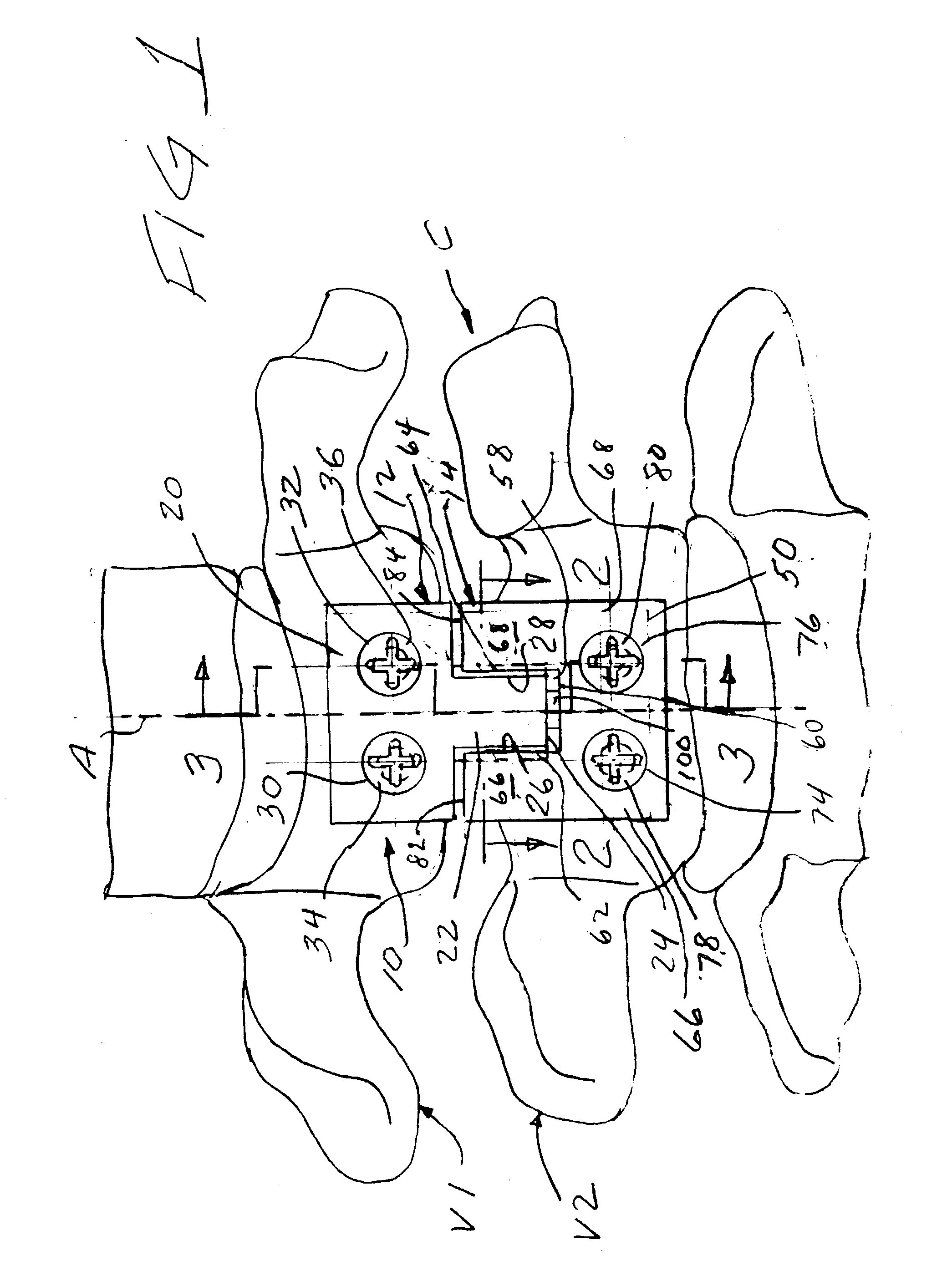 Methods and apparatuses for promoting fusion of vertebrae