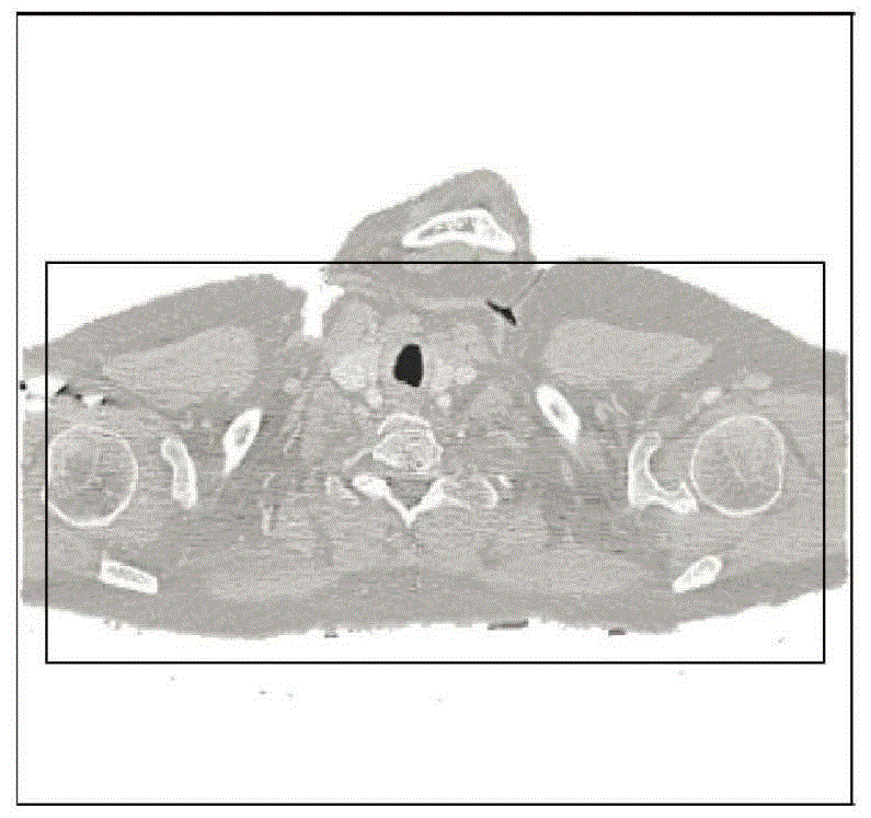 Lung cancer image fine classification method based on fusion of LBP and wavelet moment features