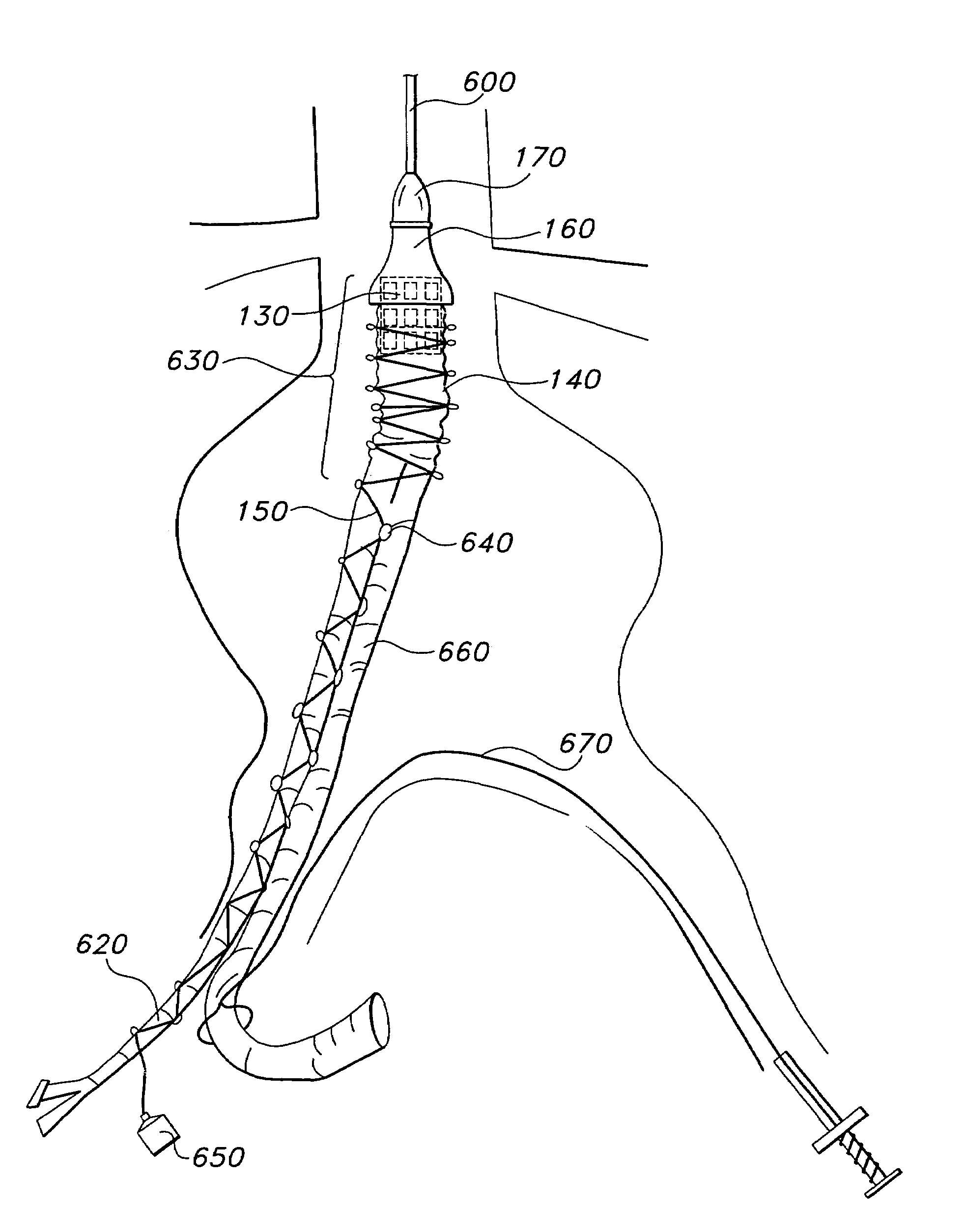 Method for inserting a prosthesis