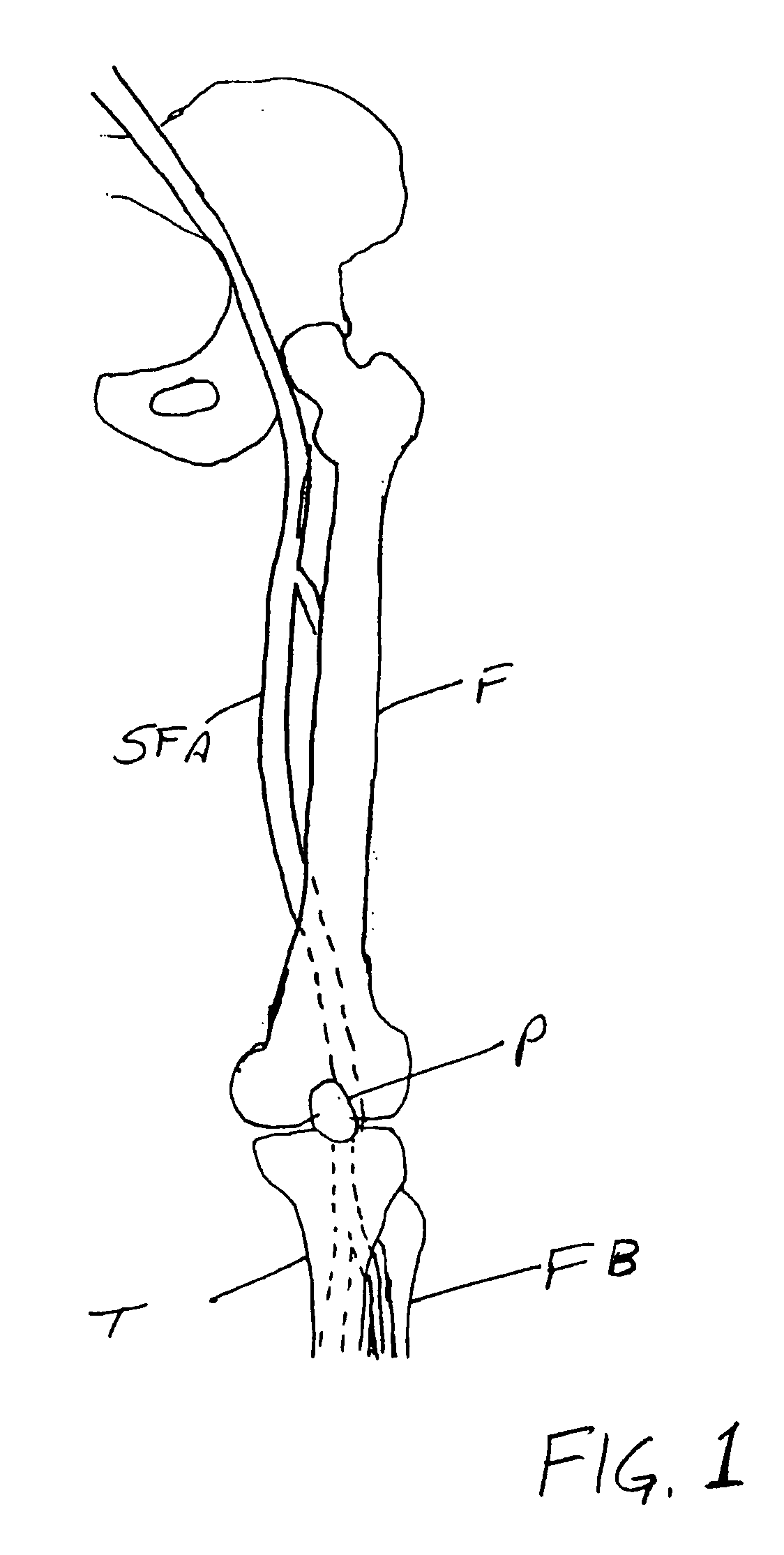 Fracture-resistant helical stent incorporating bistable cells and methods of use