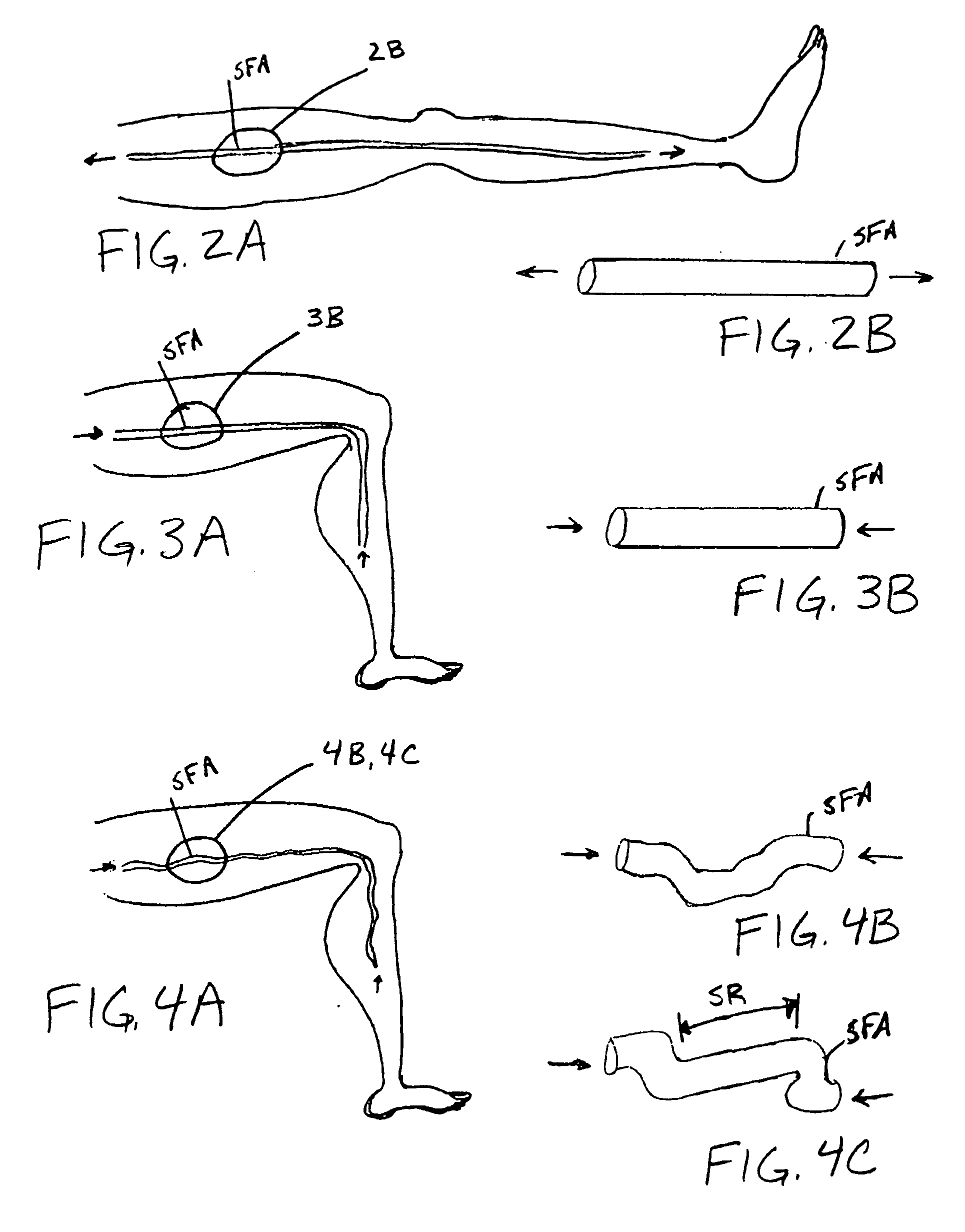 Fracture-resistant helical stent incorporating bistable cells and methods of use