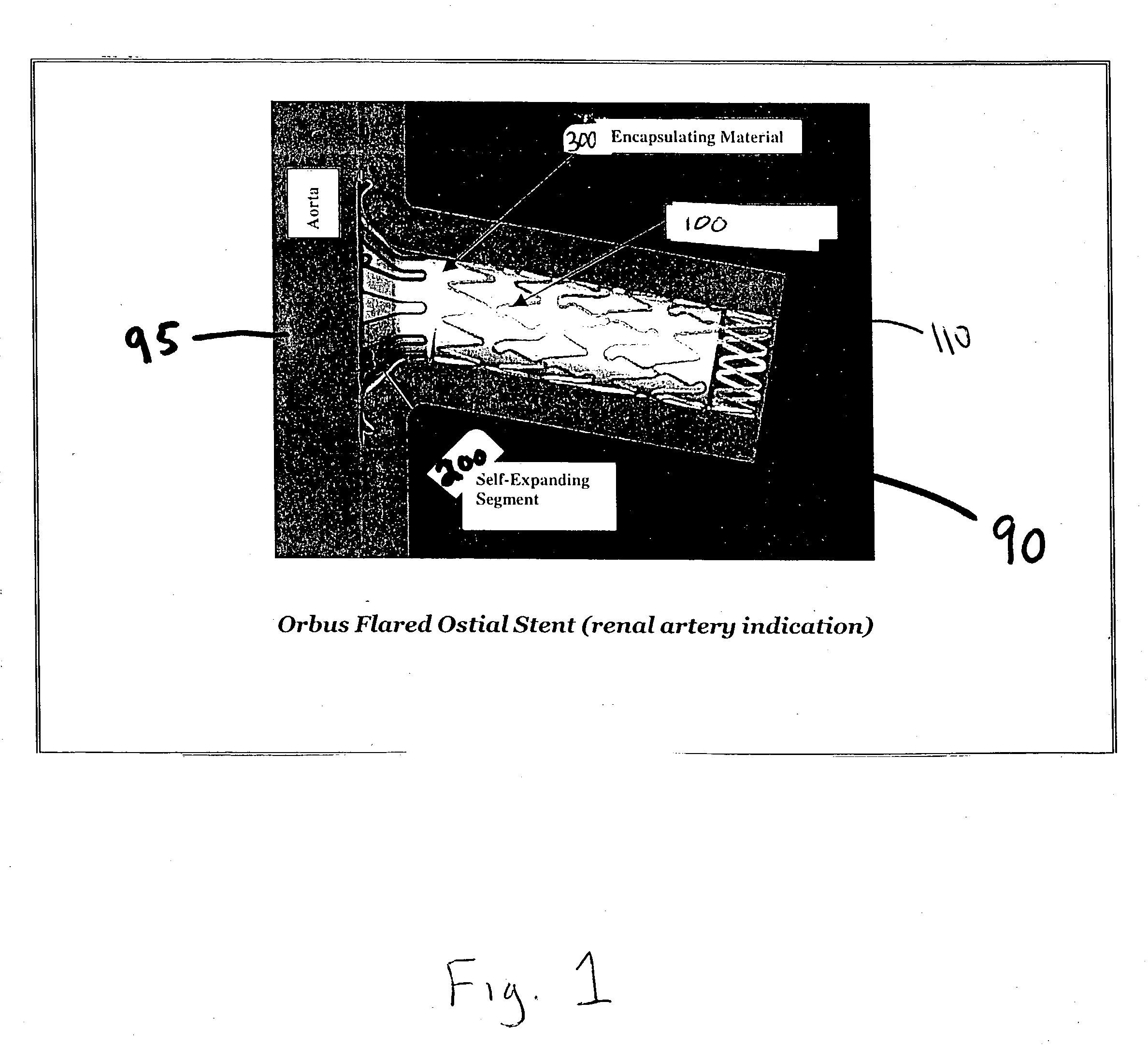 Flared ostial endoprosthesis and delivery system