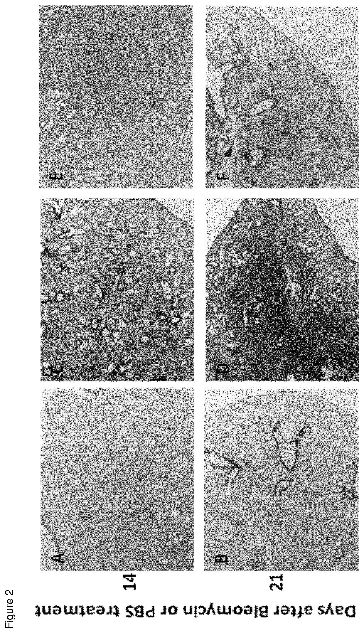 Method for the treatment of idiopathic pulmonary fibrosis