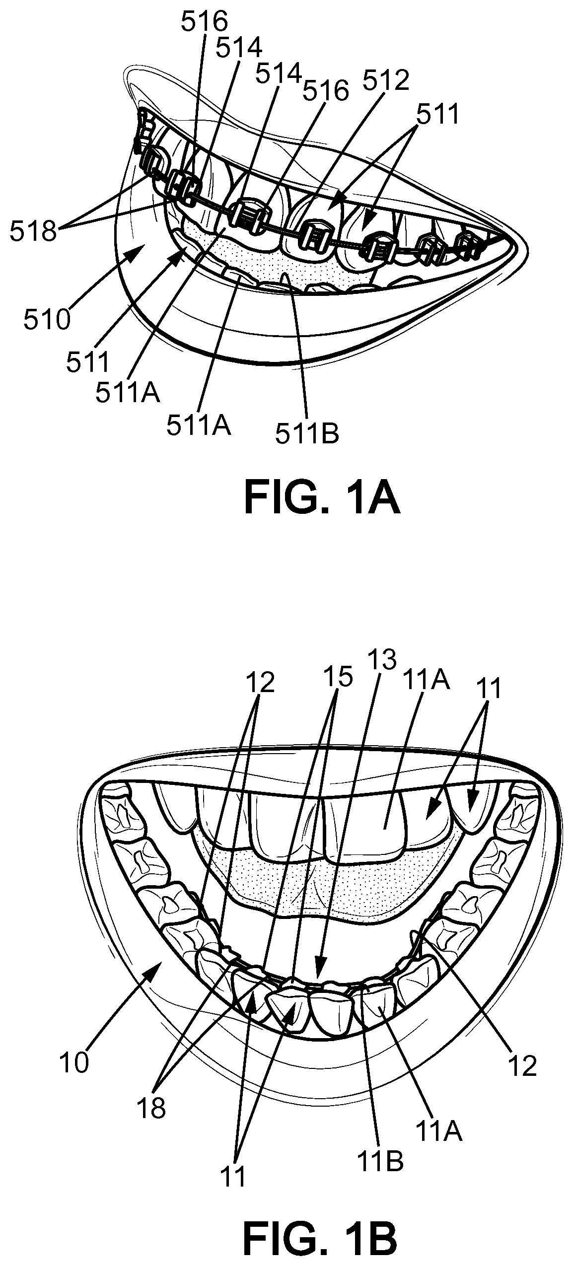 An orthodontic system for the orthodontic treatment of a patient's teeth, a method for the placement of an appliance for the orthodontic treatment of a patient's teeth, and a use of the appliance of such an orthodontic system