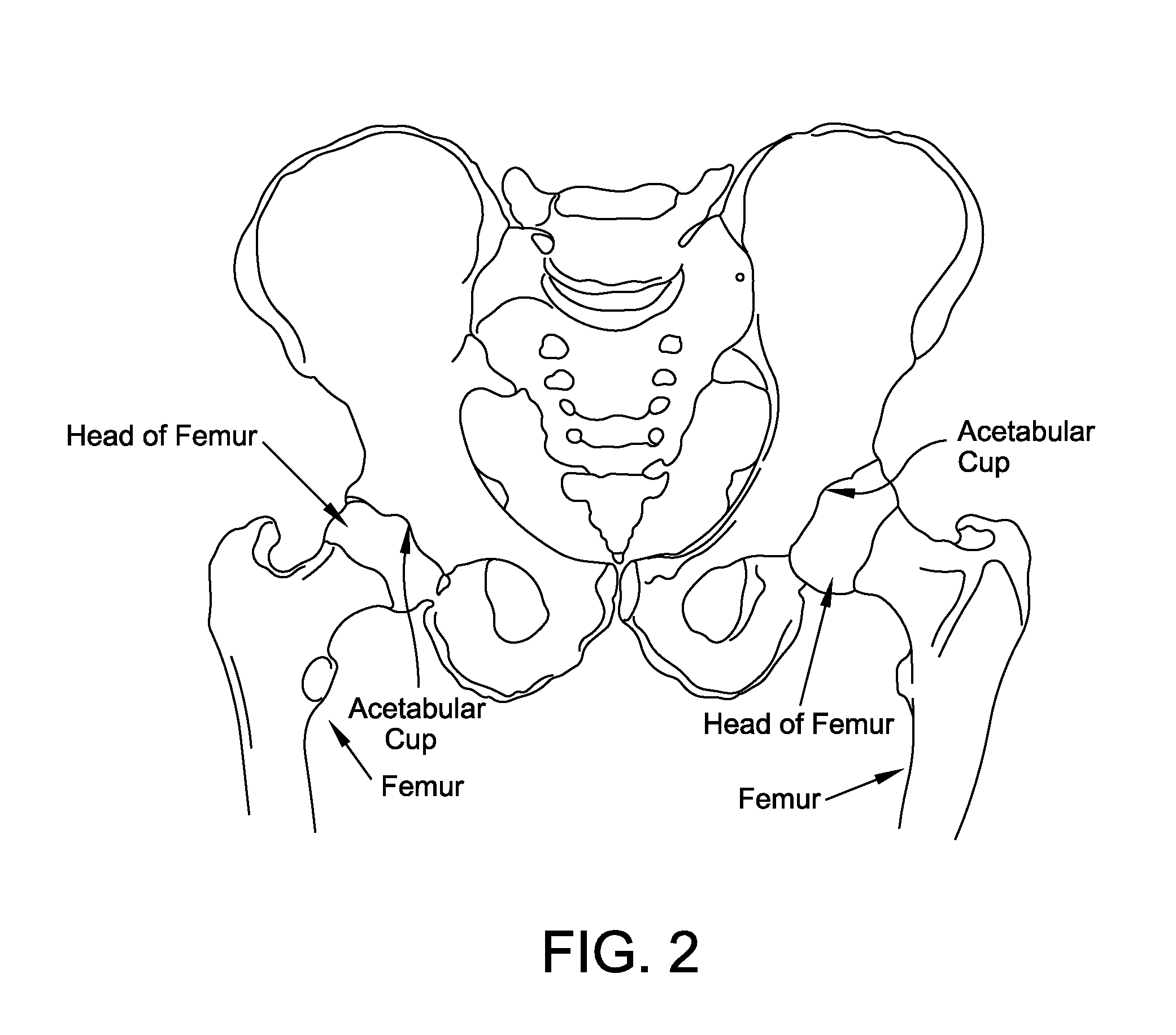 Method and apparatus for distracting a joint