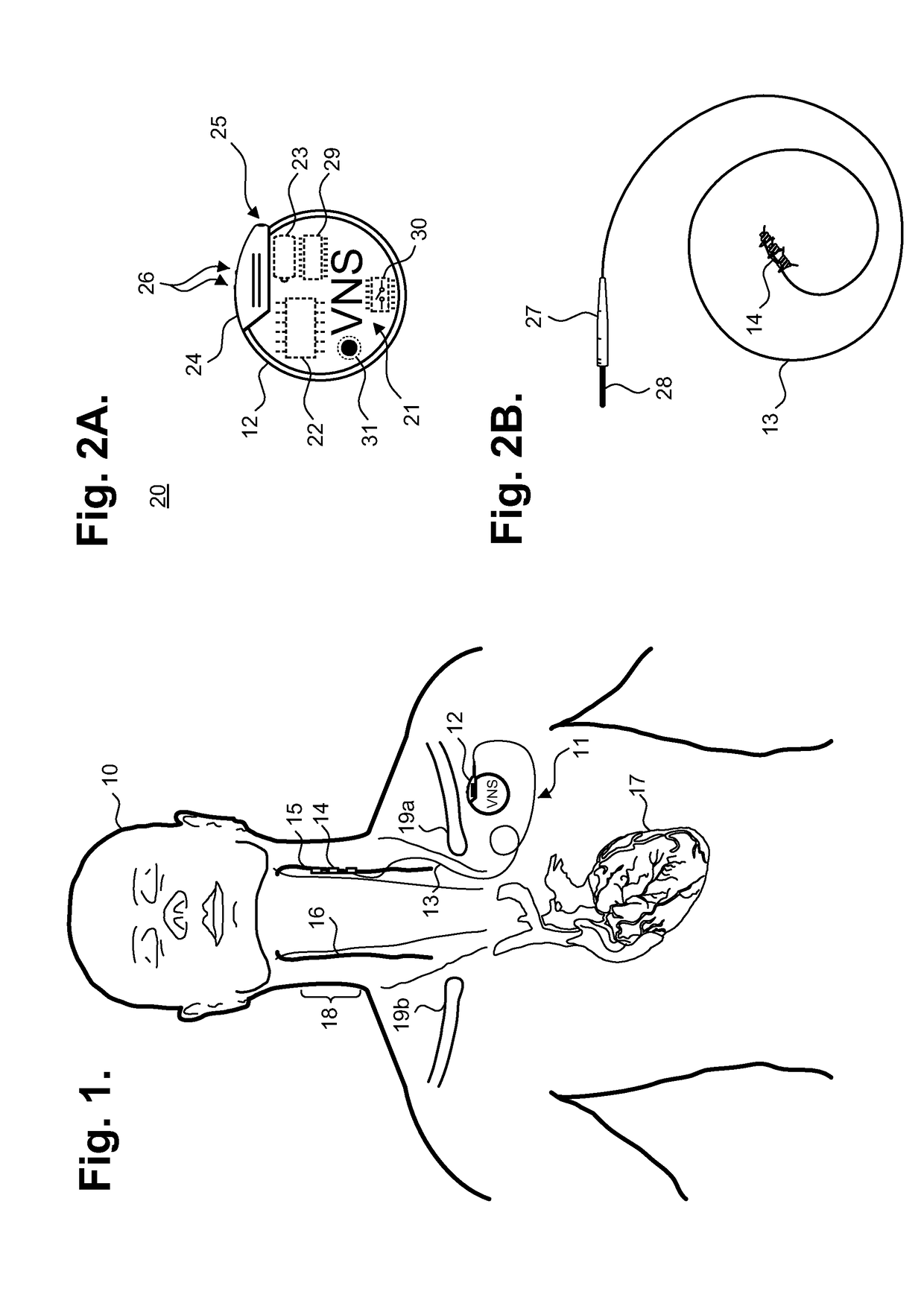 Implantable neurostimulator-implemented method for managing techyarrhythmia through vagus nerve stimulation