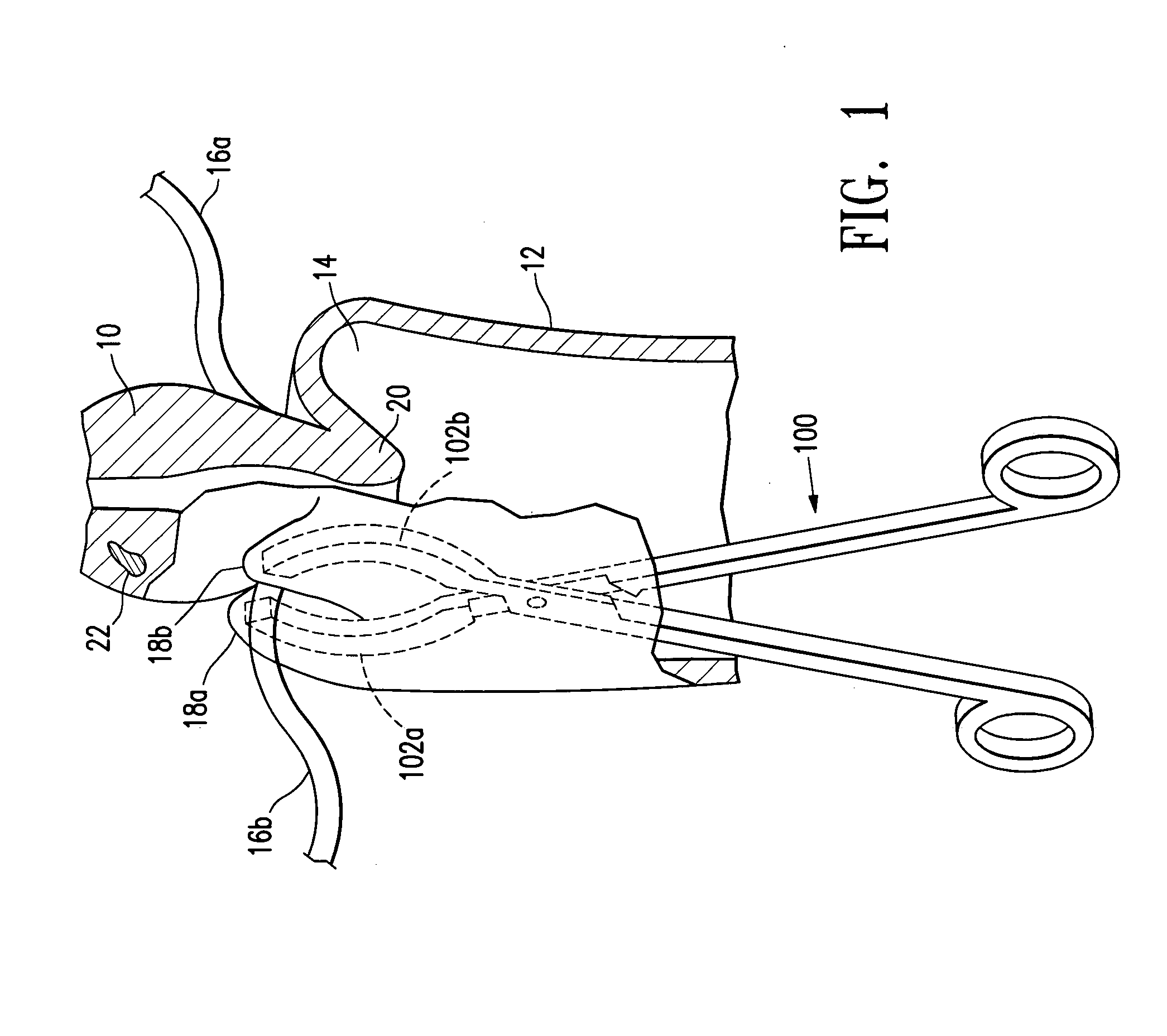 Methods for minimally-invasive, non-permanent occlusion of a uterine artery