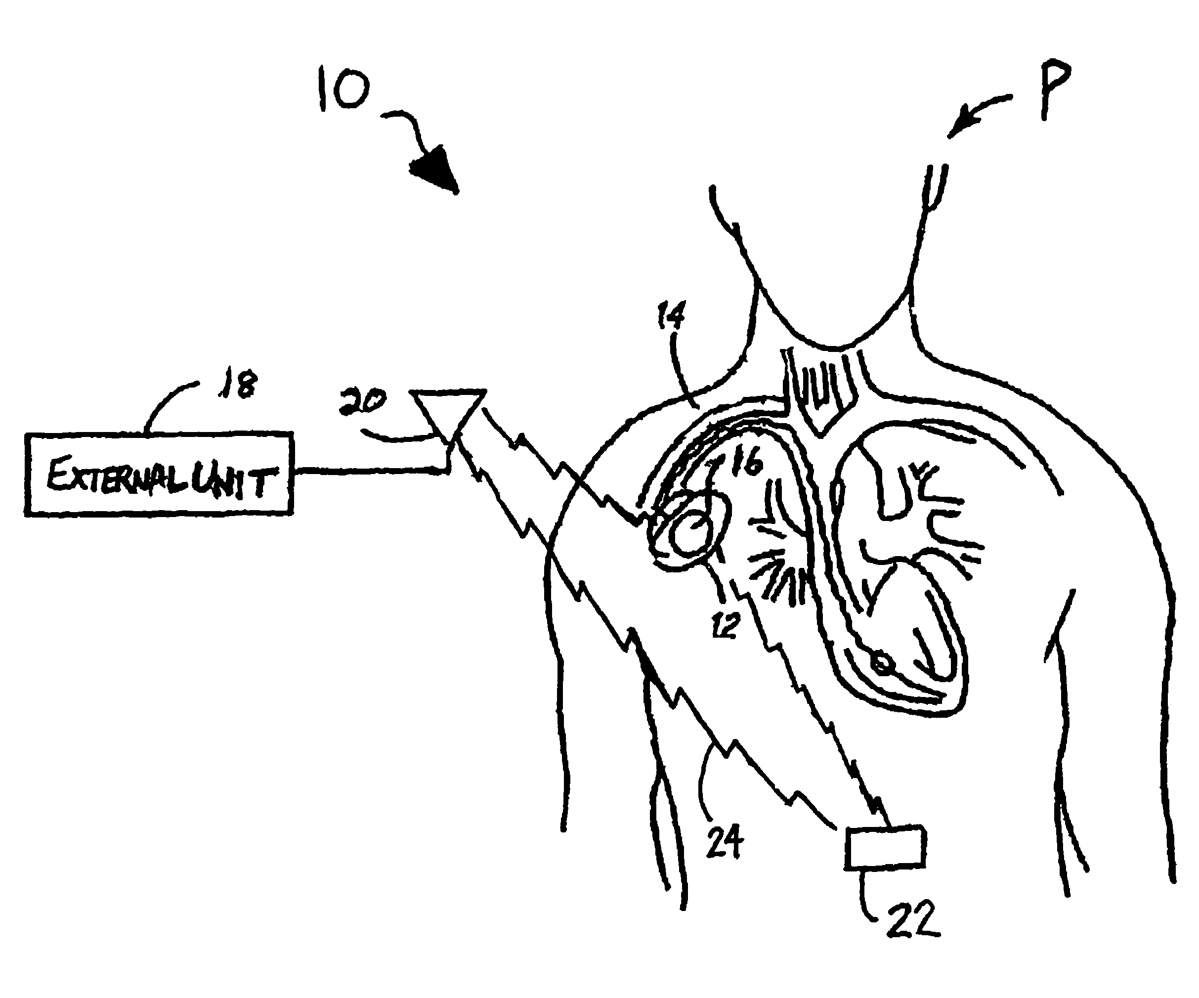 System and method for synchronous wireless communication with a medical device