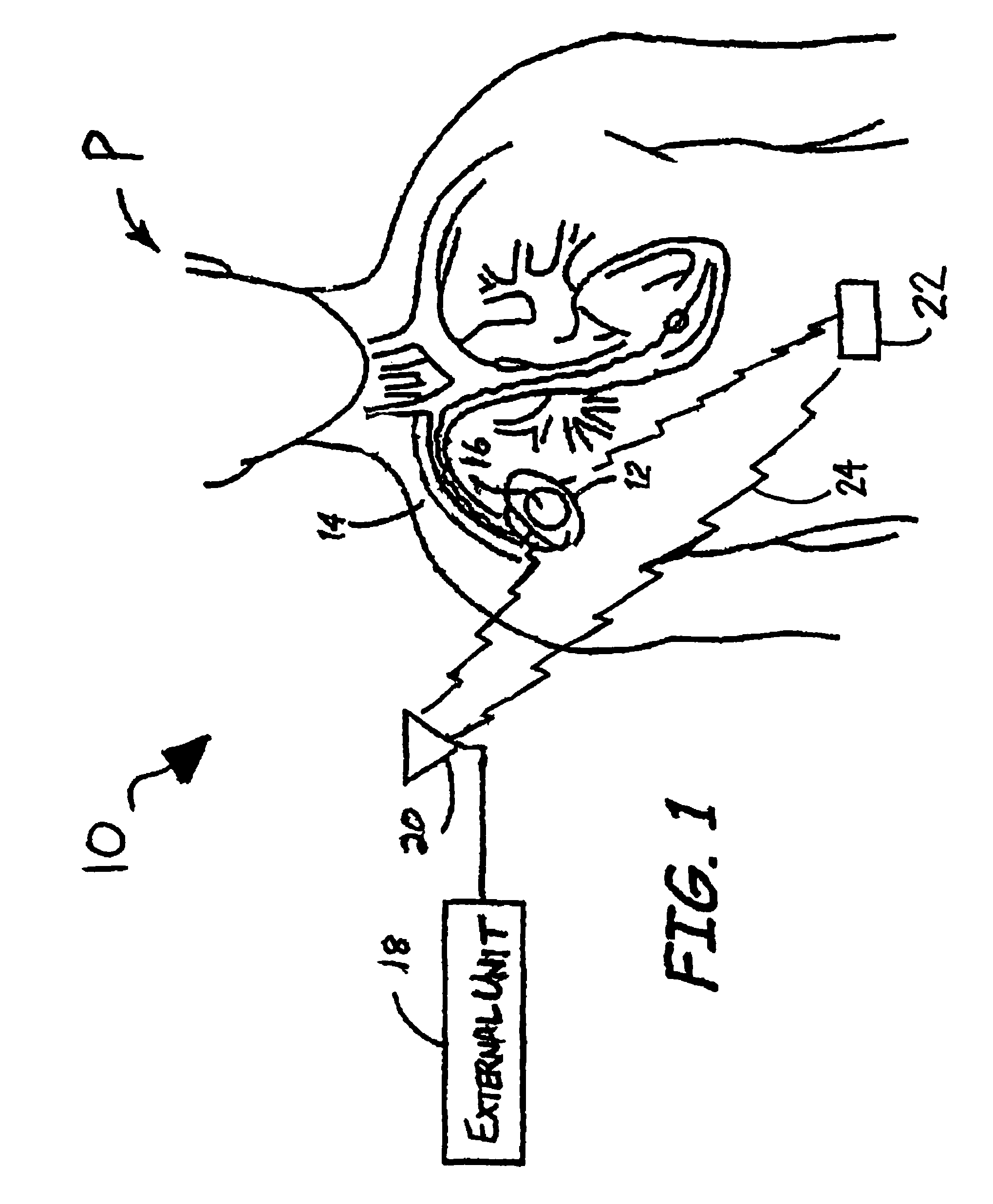 System and method for synchronous wireless communication with a medical device