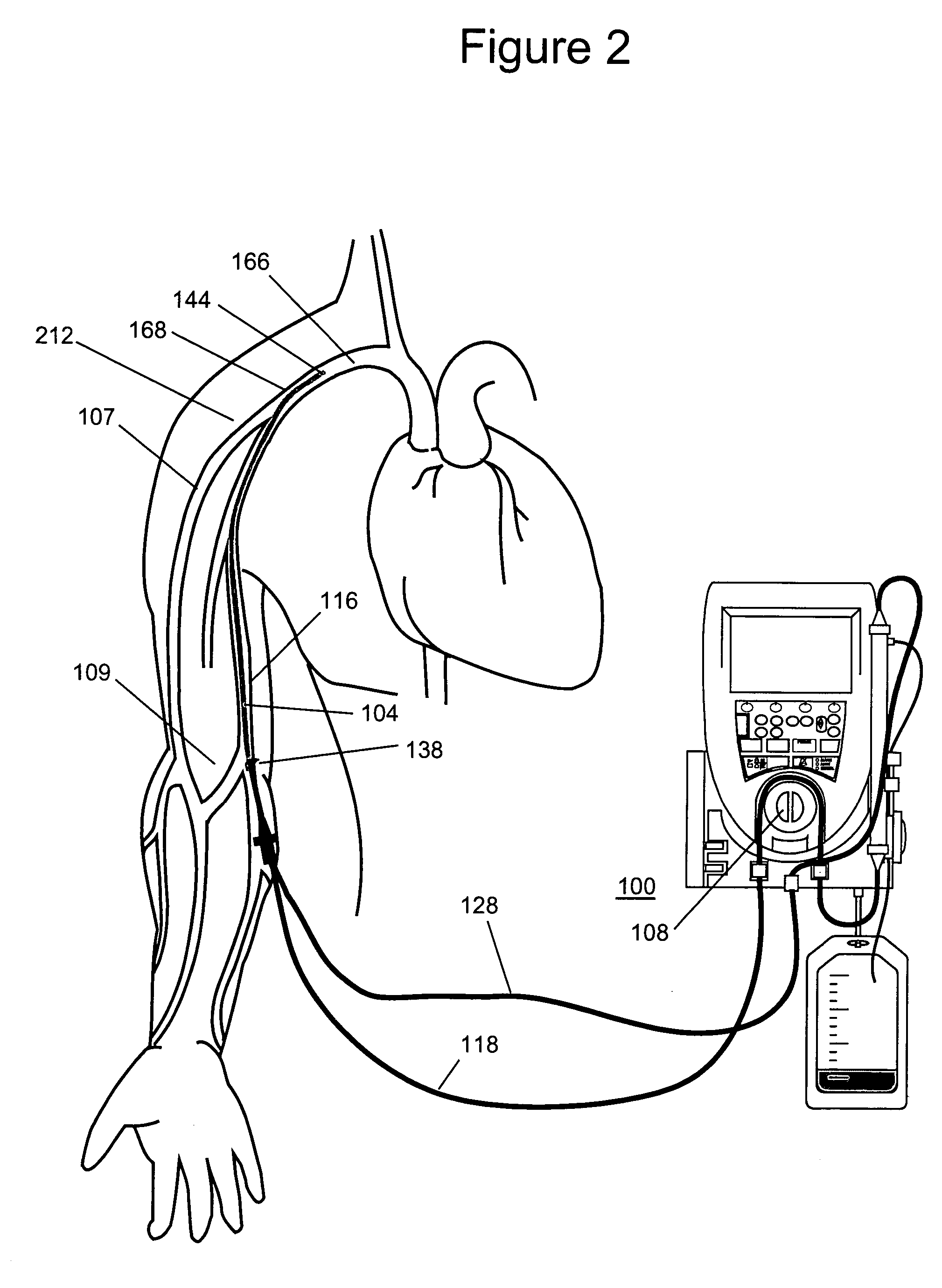 Method and apparatus for ultrafiltration utilizing a peripheral access dual lumen venous cannula