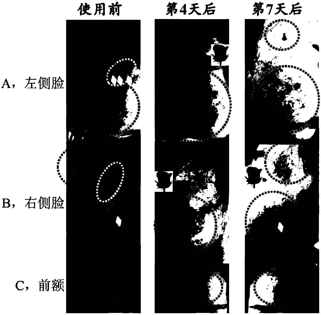 Acne-removing essence for external use for treating facial acne and preparation method and applications thereof