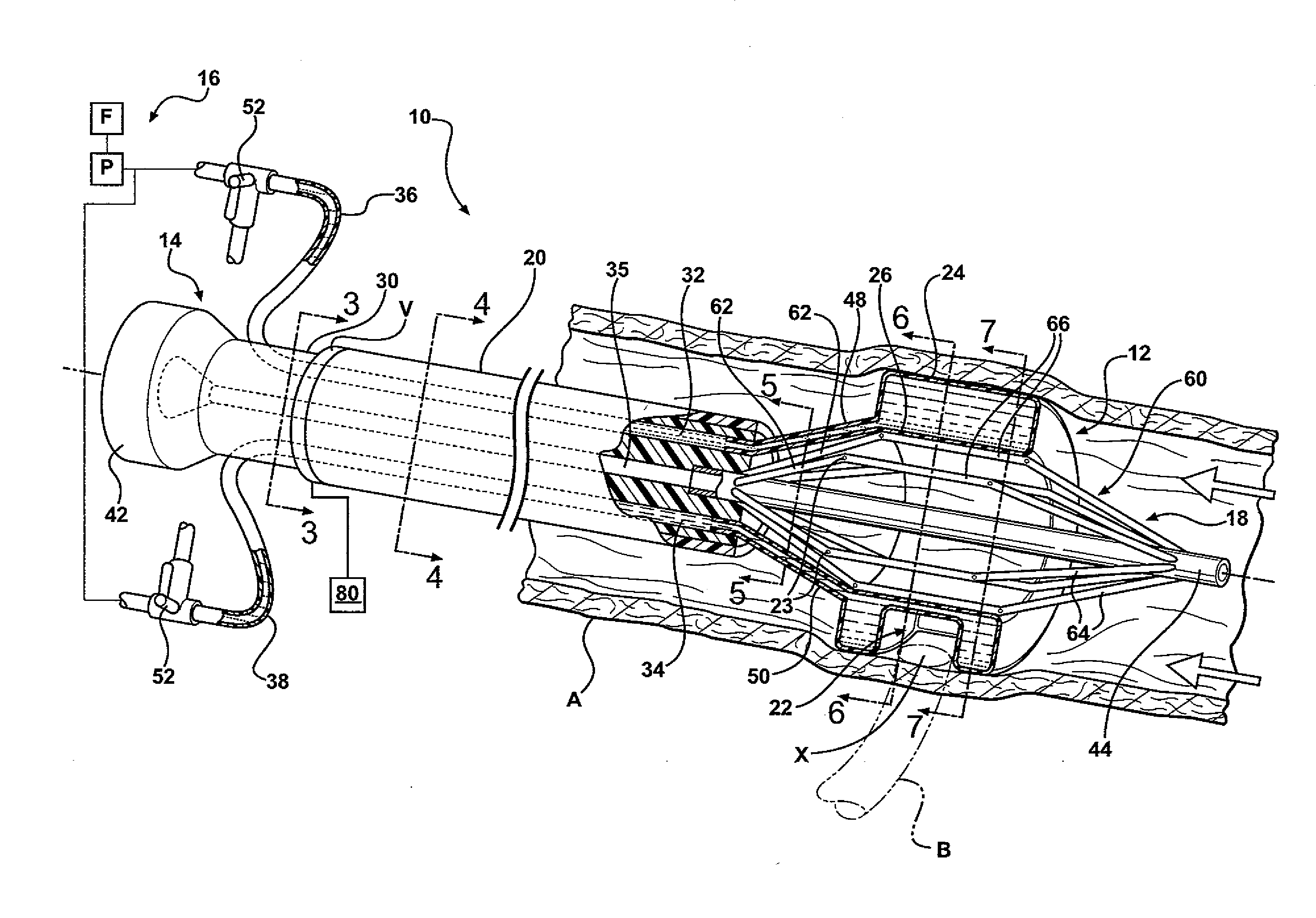 Clampless anastomotic device