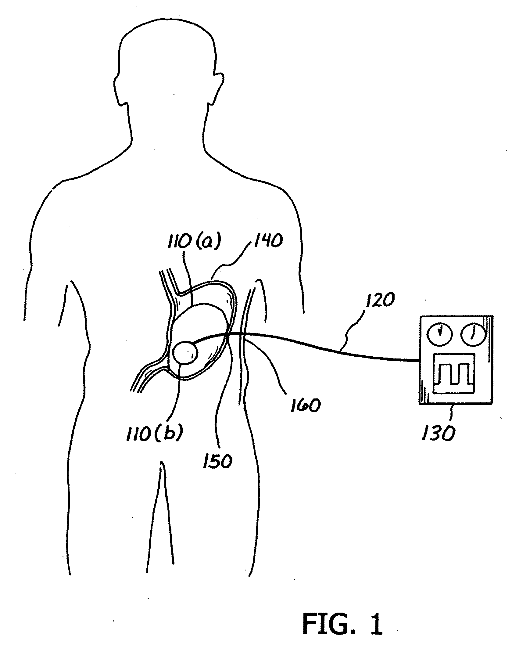 Balloon system and methods for treating obesity