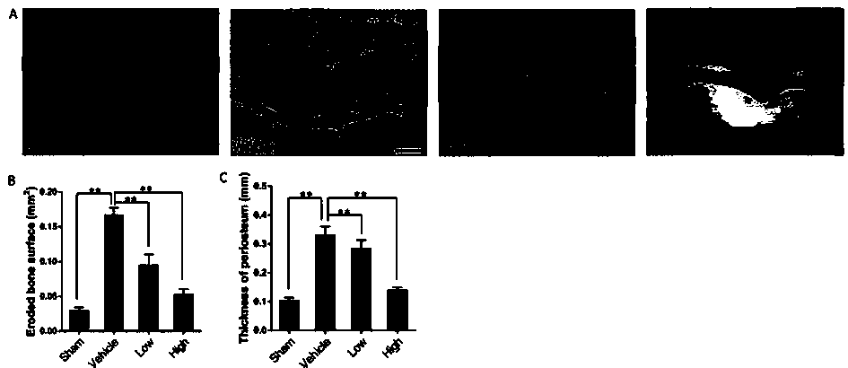 Use of melatonin in the preparation of medicines for treating chronic inflammation and bone destruction around loose prostheses