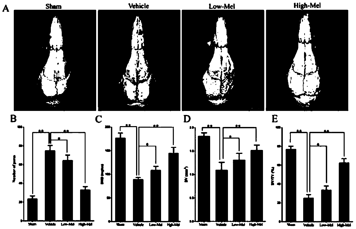 Use of melatonin in the preparation of medicines for treating chronic inflammation and bone destruction around loose prostheses